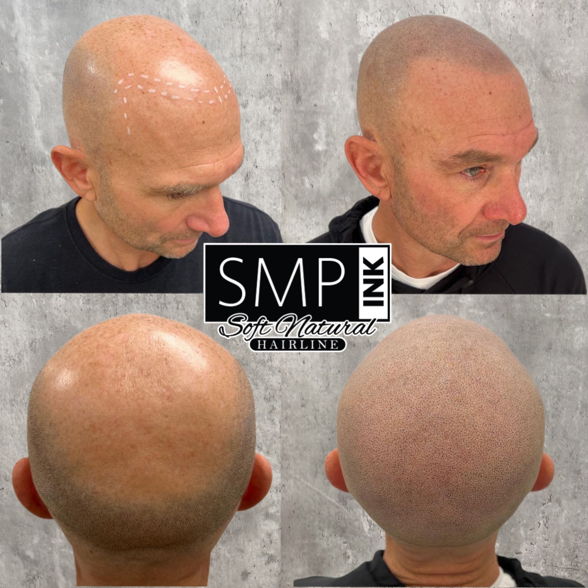 Before-and-after scalp micropigmentation results showing close-up head views from different angles.