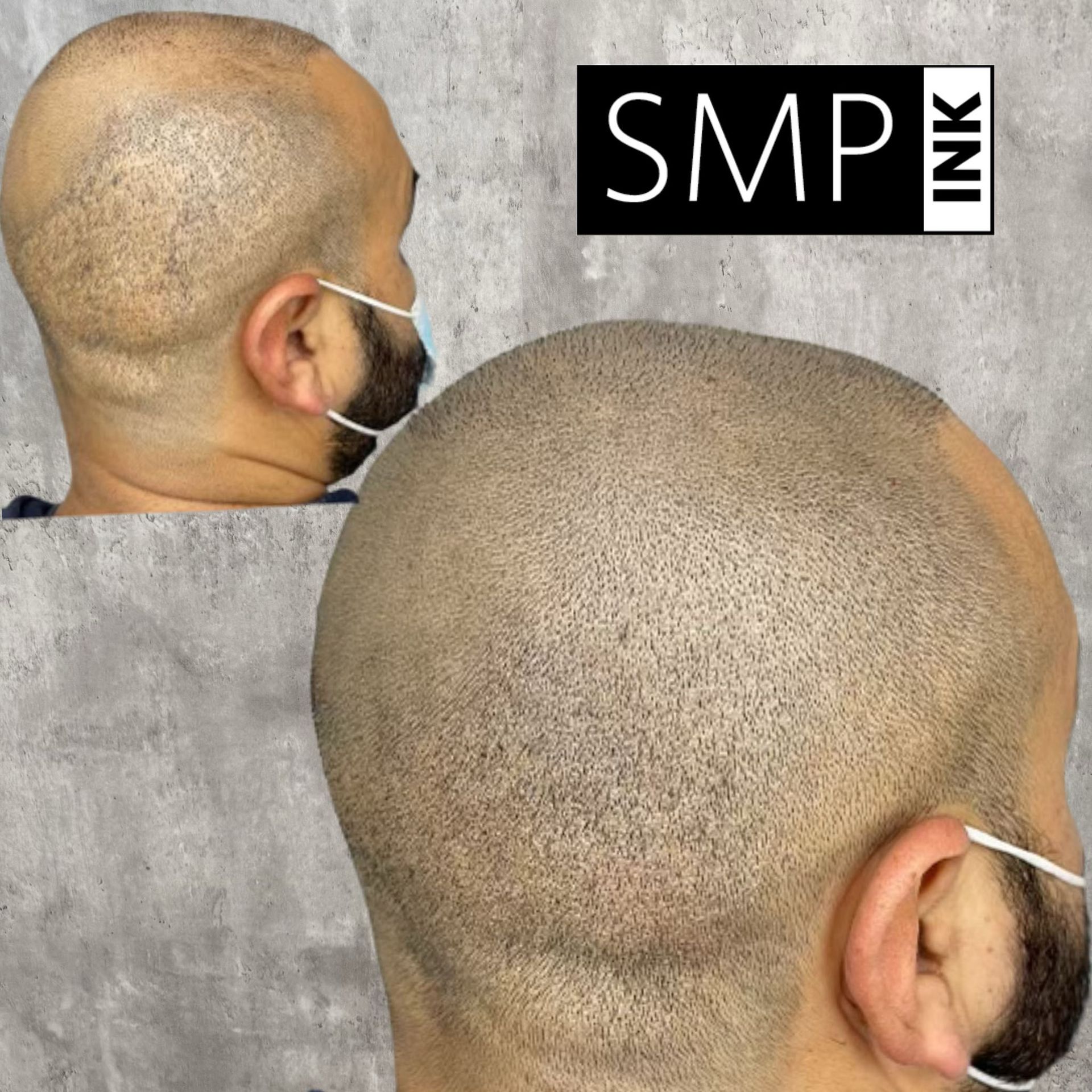 SMP scalp treatment results on a shaved head, showing close-up front and side views with a small SMP Ink logo.