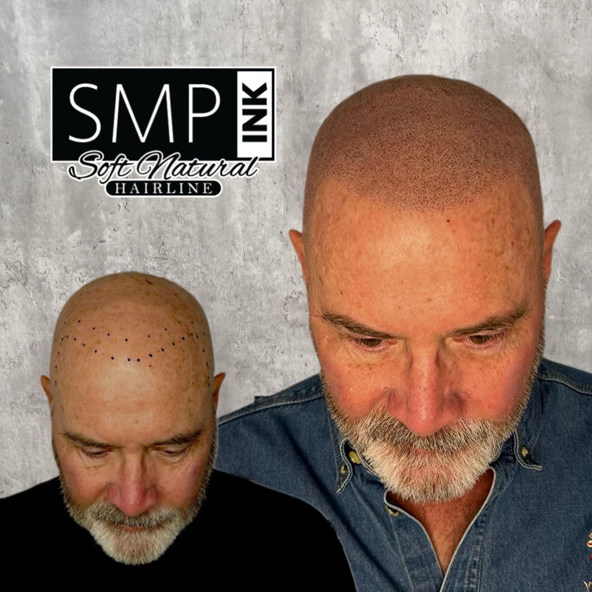 Before-and-after scalp hairline restoration promo: bald head, fuller hairline, with “SMP Ink” text.