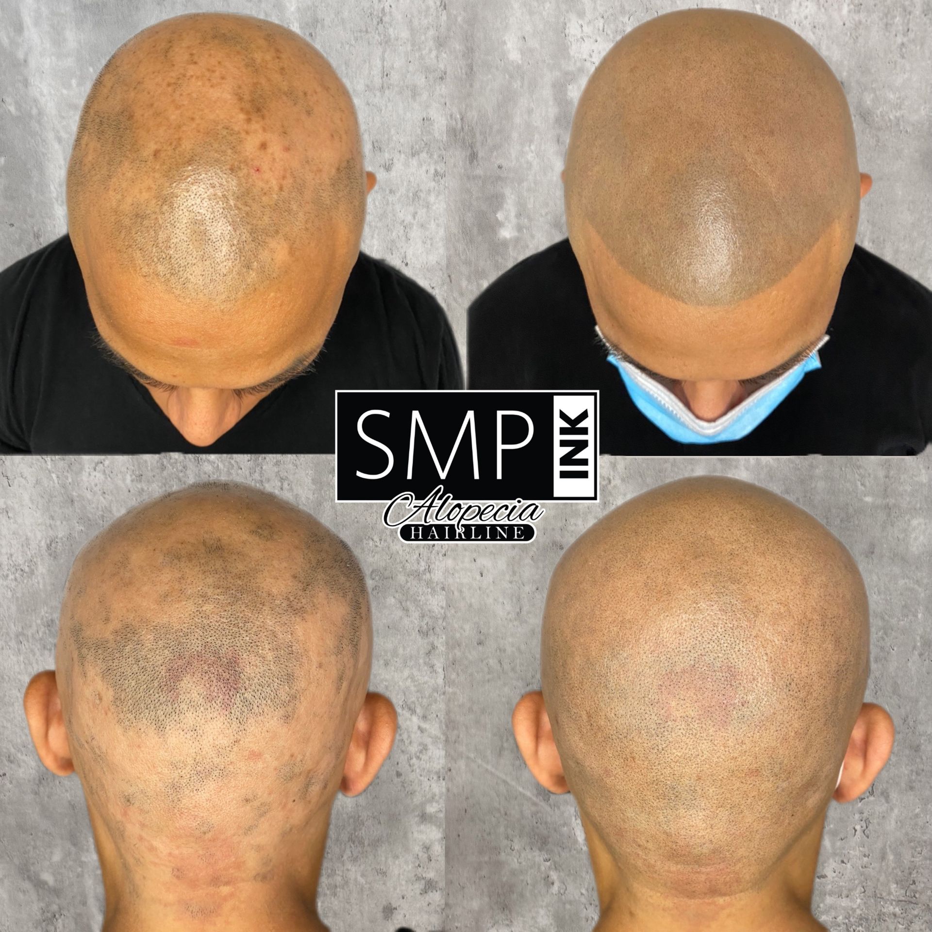Before-and-after scalp micropigmentation results shown in four views of a shaved head.