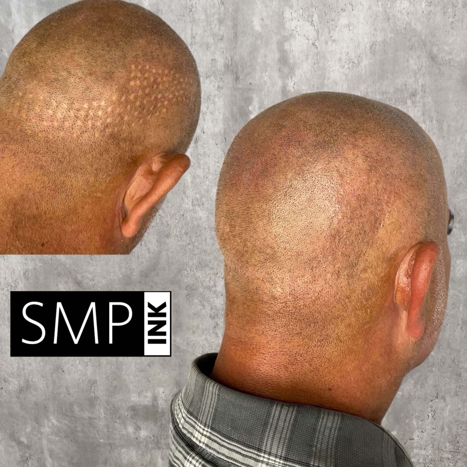 Two views of a shaved scalp and neck with a gray concrete background; SMP INK logo visible