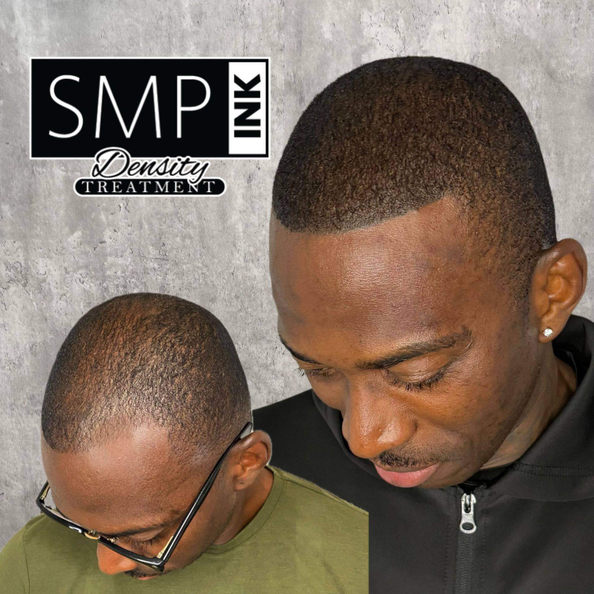 Before-and-after close-up of a man’s scalp showing SMP Ink density treatment results.
