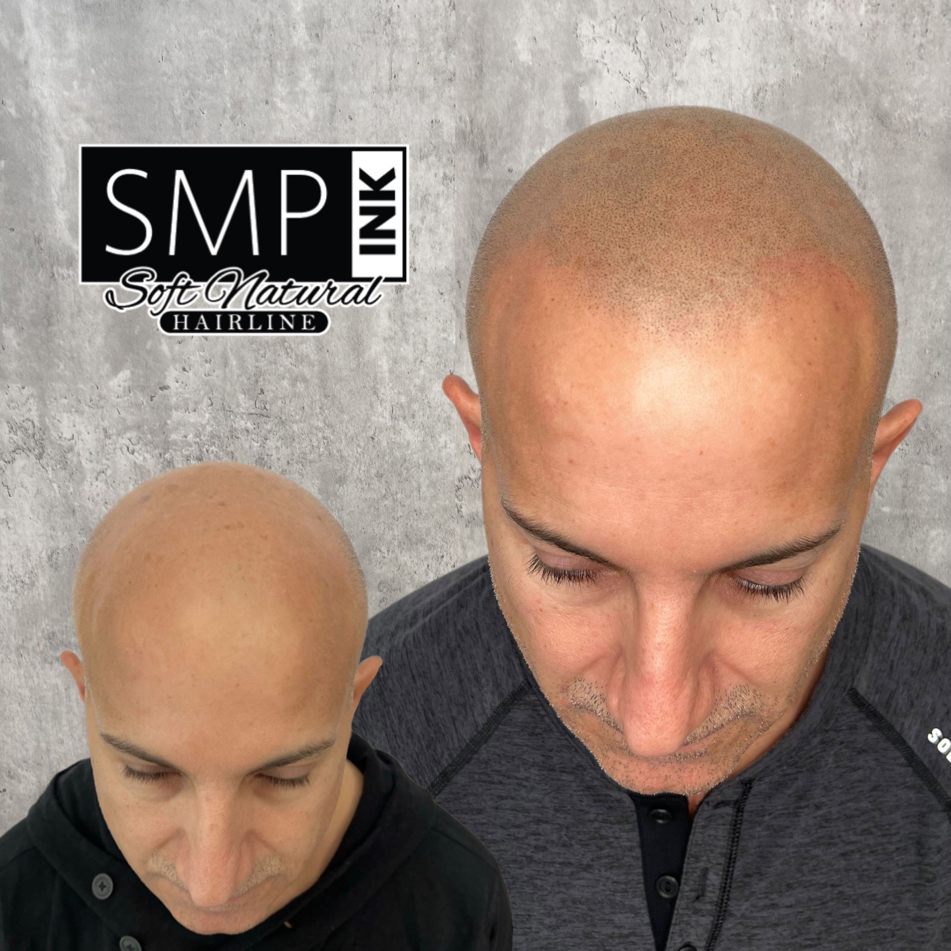 Before-and-after scalp comparison showing bald head with and without SMP hairline tattoo treatment.