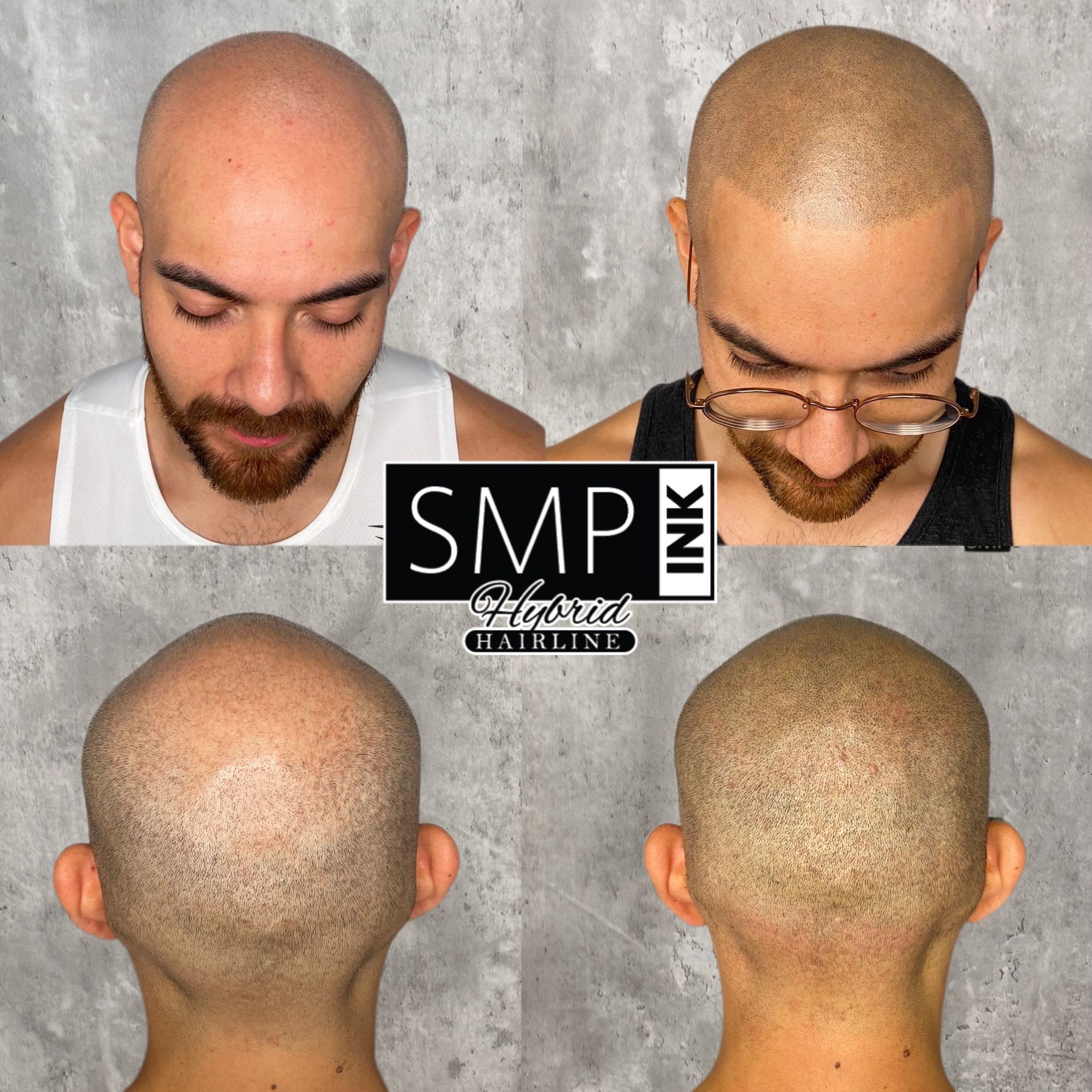 Before-and-after scalp micropigmentation photos showing a bald head and the finished hairline from multiple angles.