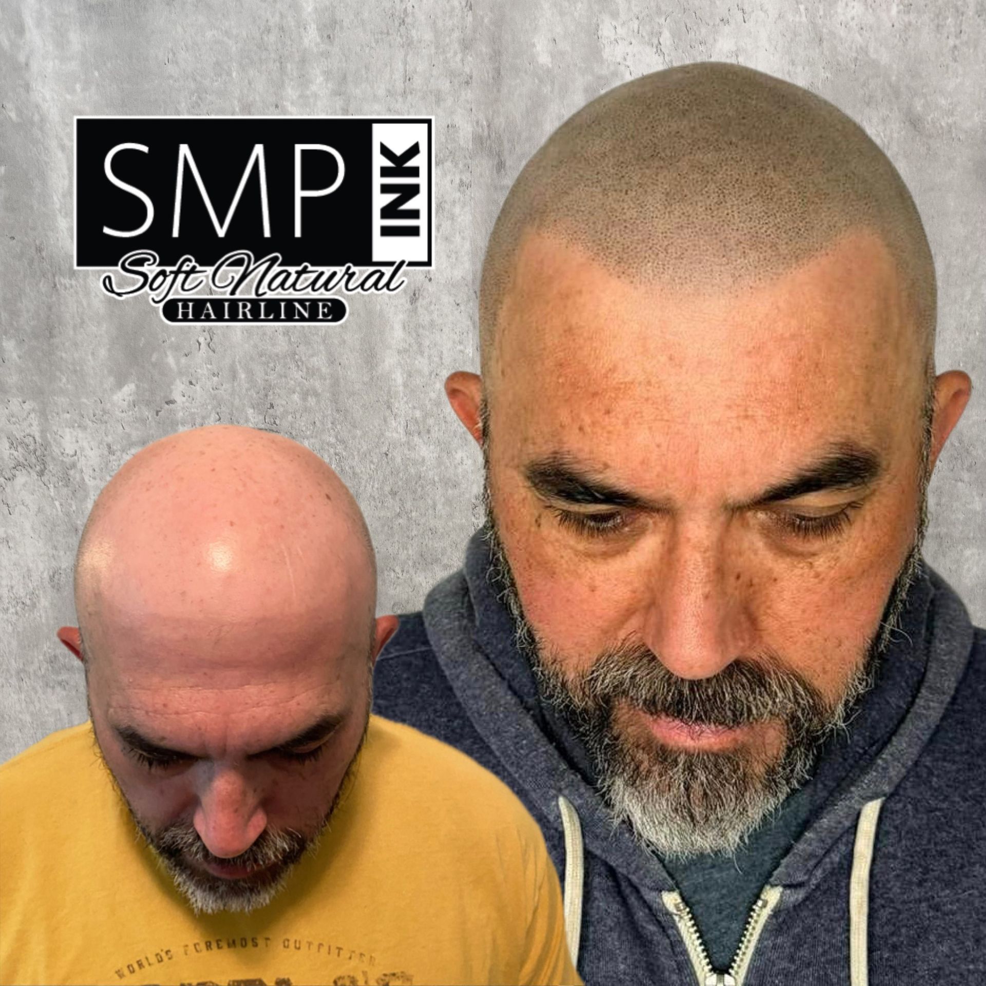 Before-and-after scalp treatment comparison showing a bald head transformed to short hair, with SMP Ink logo.