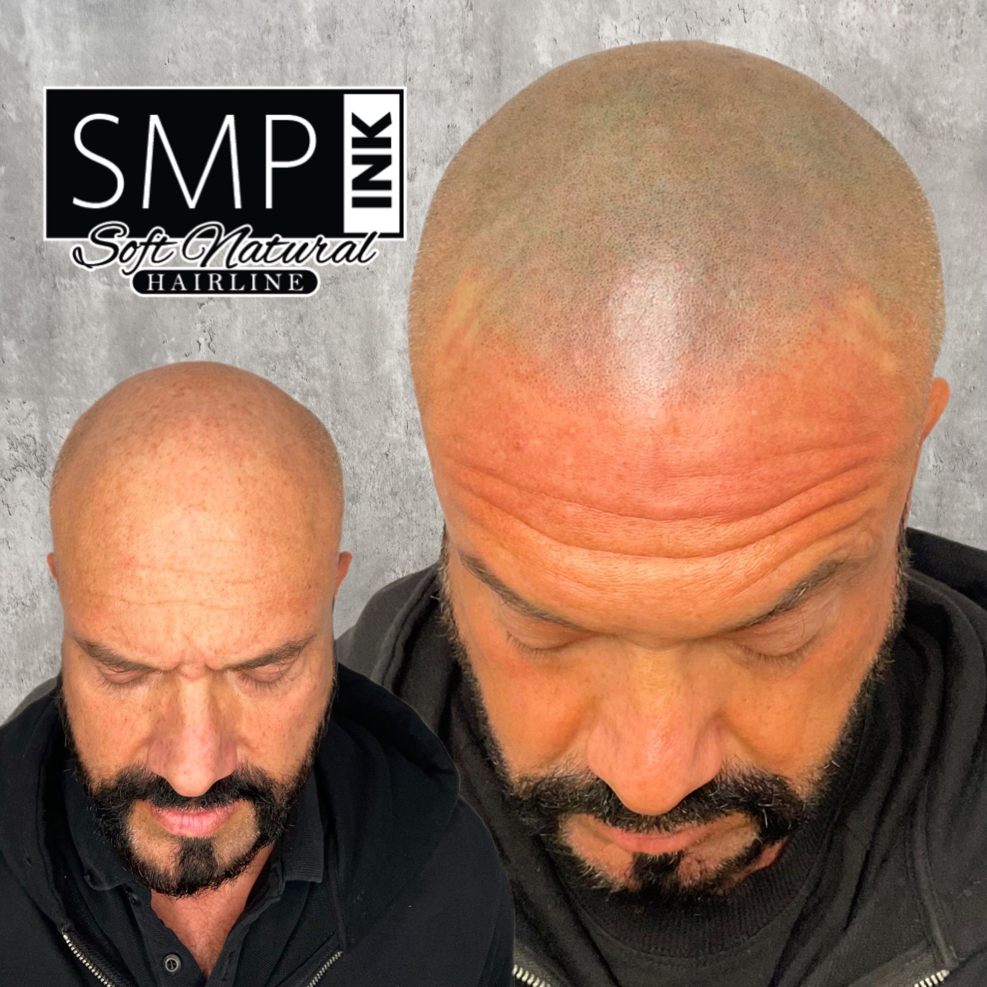 Before-and-after bald scalp treatment on a man, with logo in the corner.