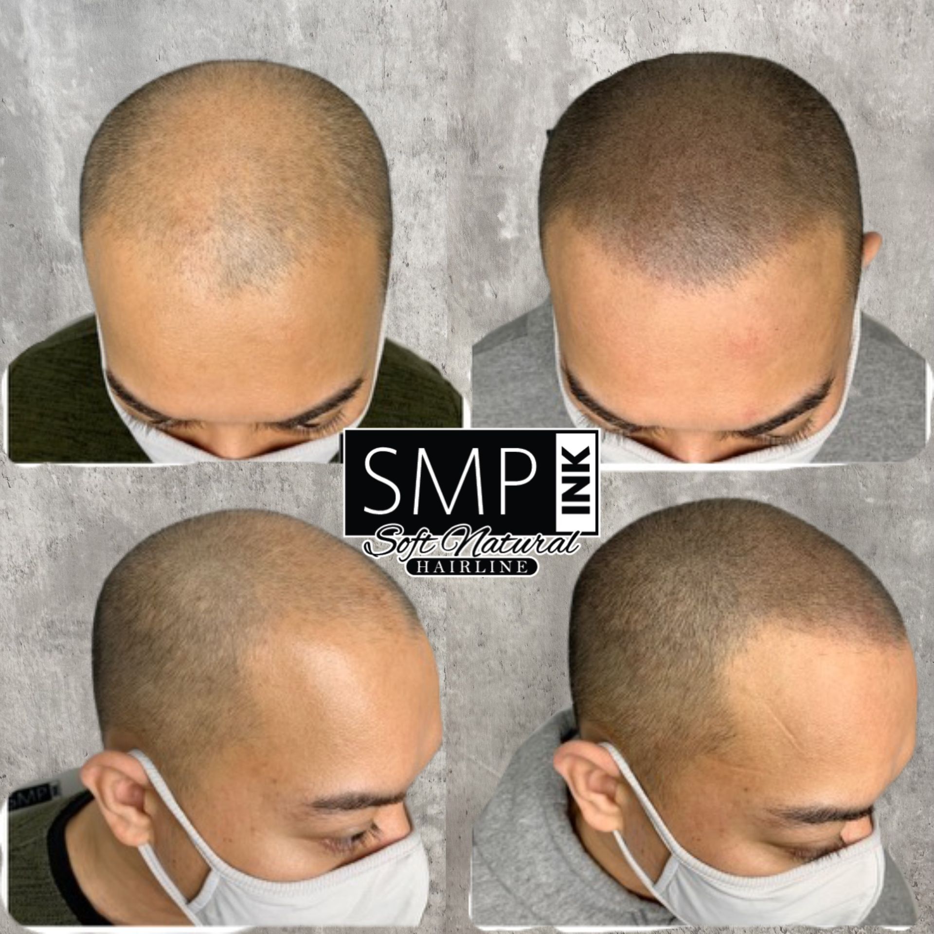 Four views of a shaved scalp with SMP hairline restoration, shown before and after from different angles.