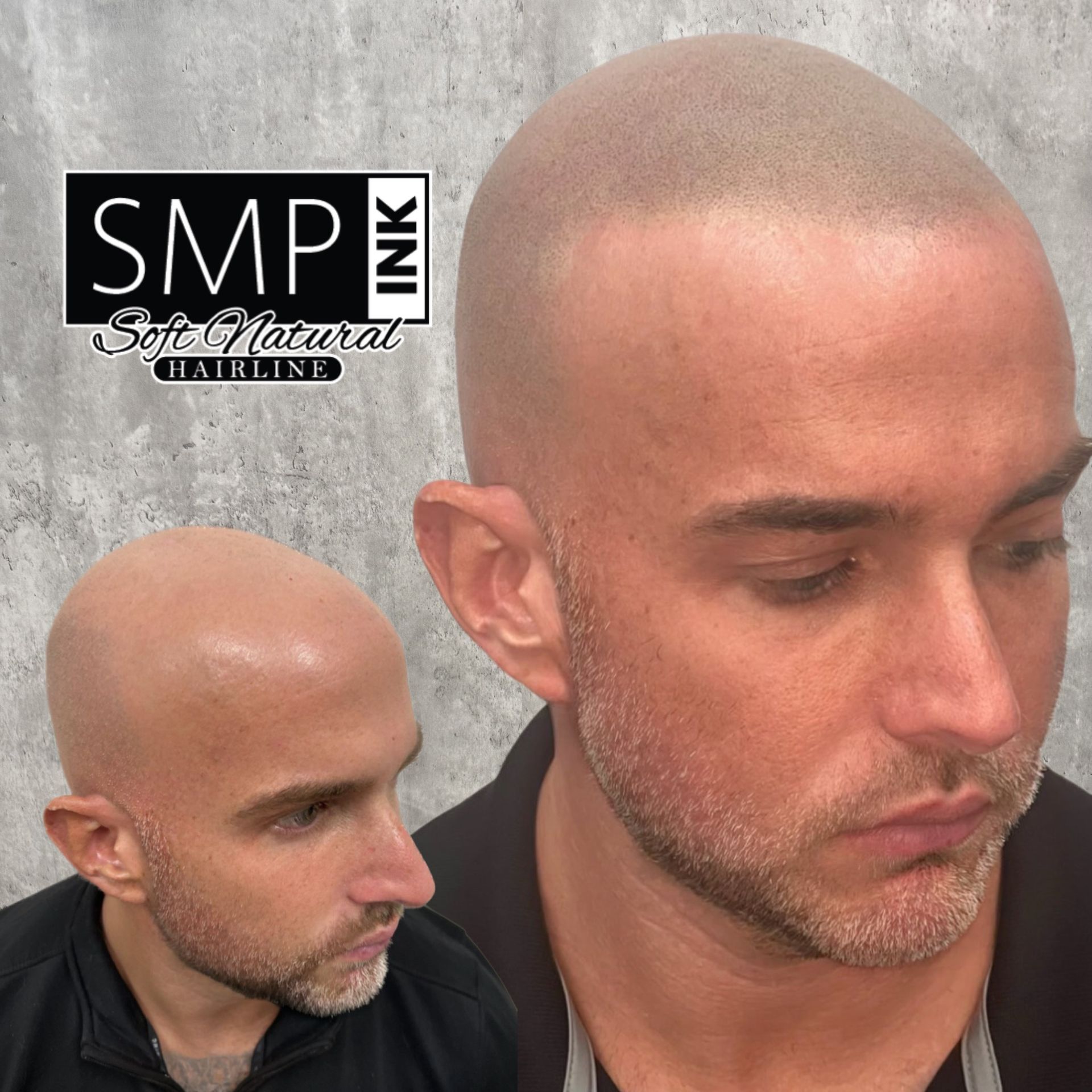 Split image showing a bald man’s scalp before and after SMP ink treatment, with logo text in the corner