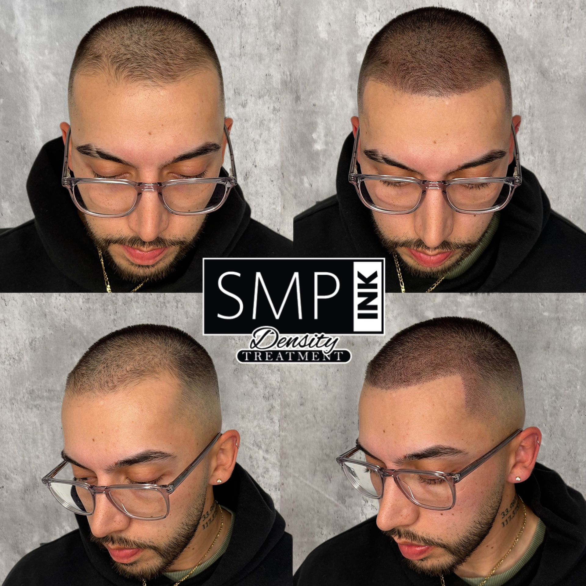 Before-and-after collage of a shaved head with SMP scalp pigmentation, shown from front and side angles
