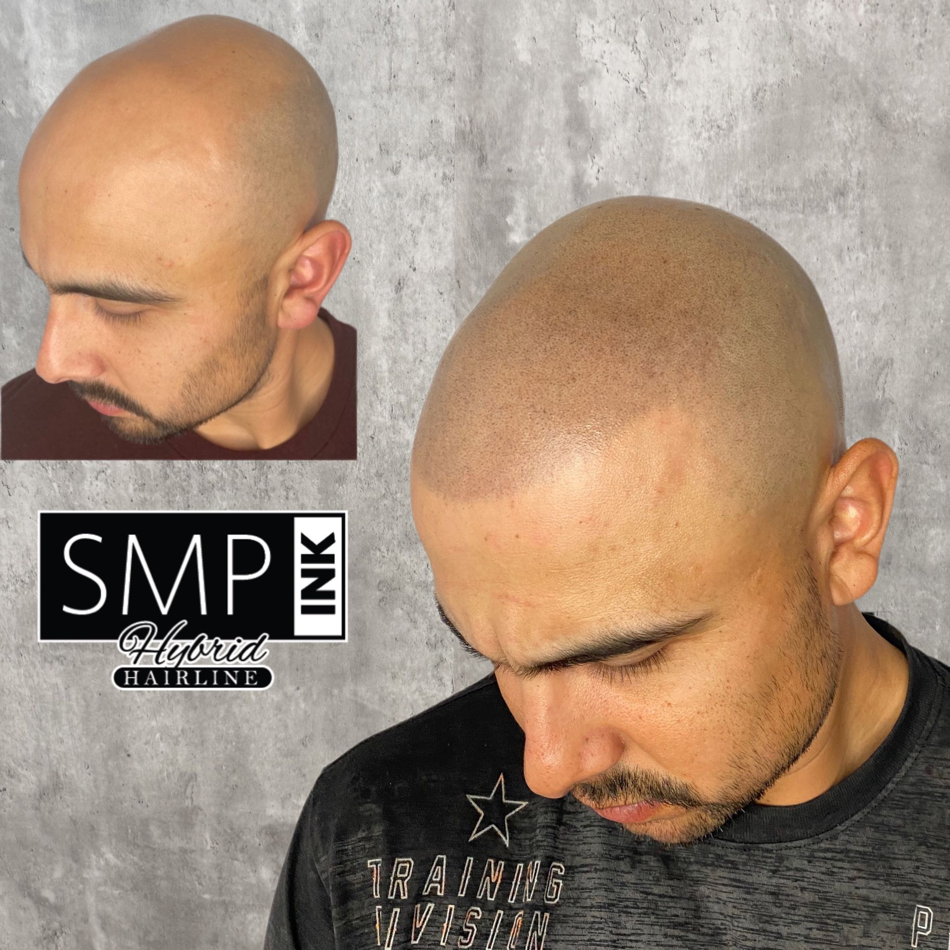 Before-and-after scalp micropigmentation on a bald head, shown from two angles against a gray background.