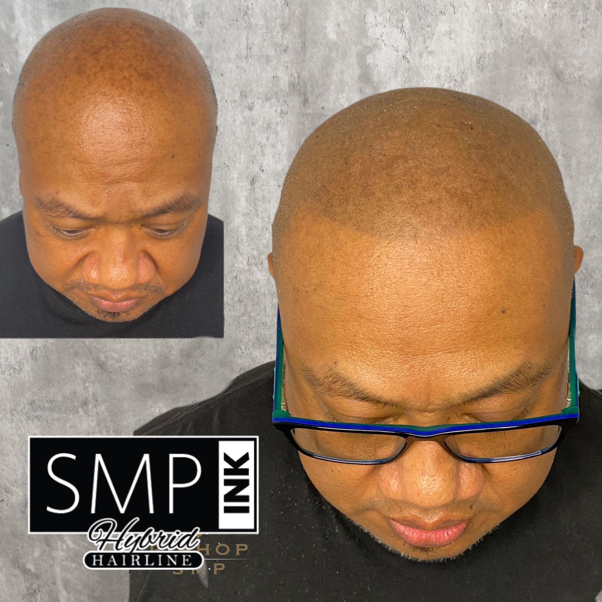 Before-and-after scalp micropigmentation close-up of a bald head, with one view wearing glasses and looking down.