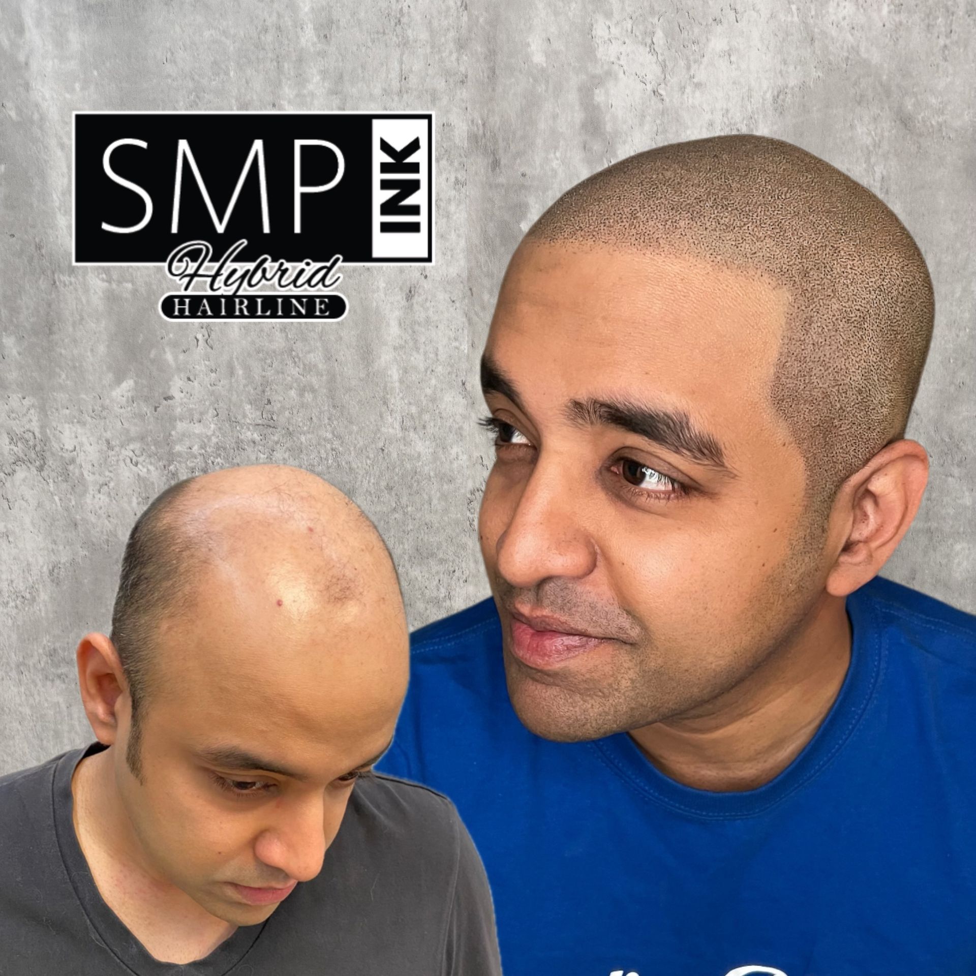 Two views of a bald head with a hairline design on a gray background; SMP Ink logo in corner