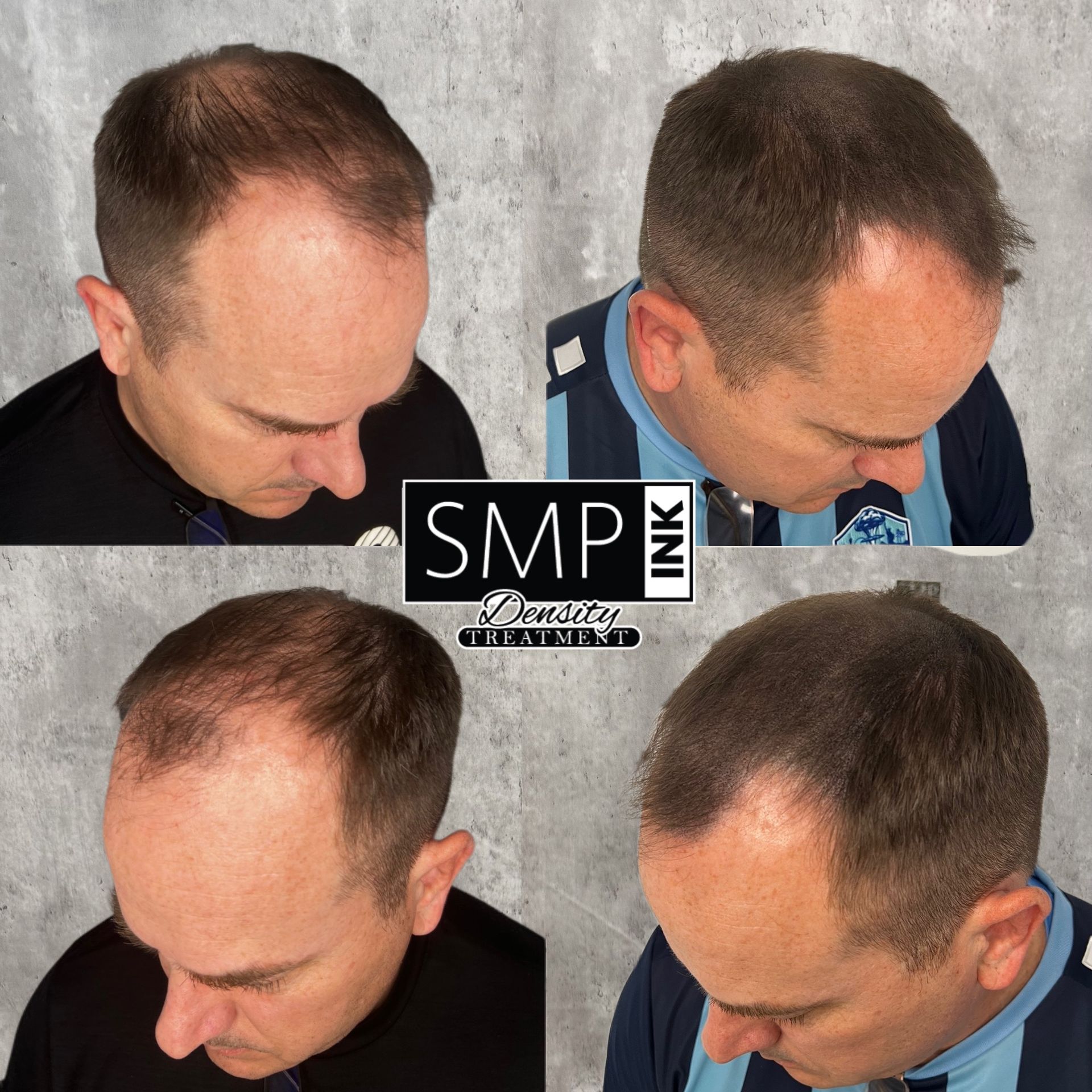 Four-panel collage showing hair transplant results on the top of a man’s head, with an SMP Ink logo in the center