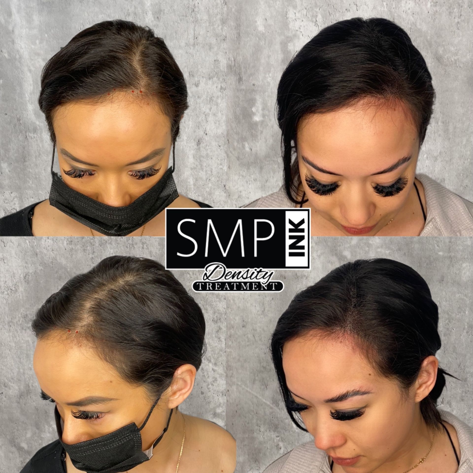Collage of four views showing scalp micropigmentation on a woman’s hairline and temple area
