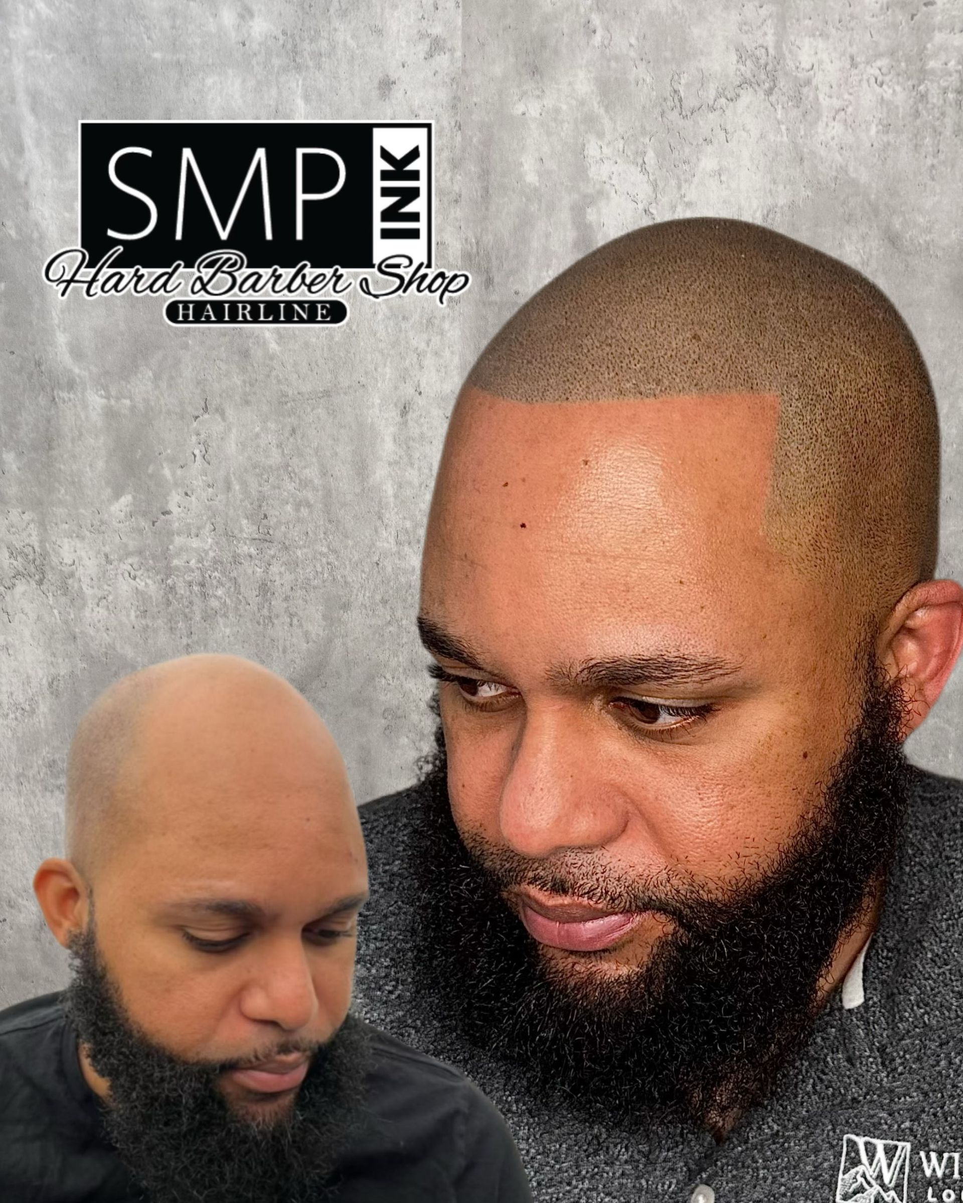 Before-and-after scalp micropigmentation showing a bald head transformed into a close-cropped hairline.
