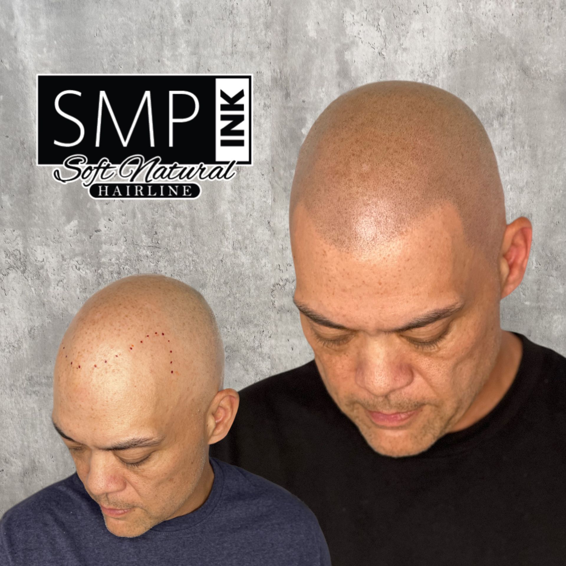 Before-and-after of a bald scalp treatment result, with logo and close-up views of the head.
