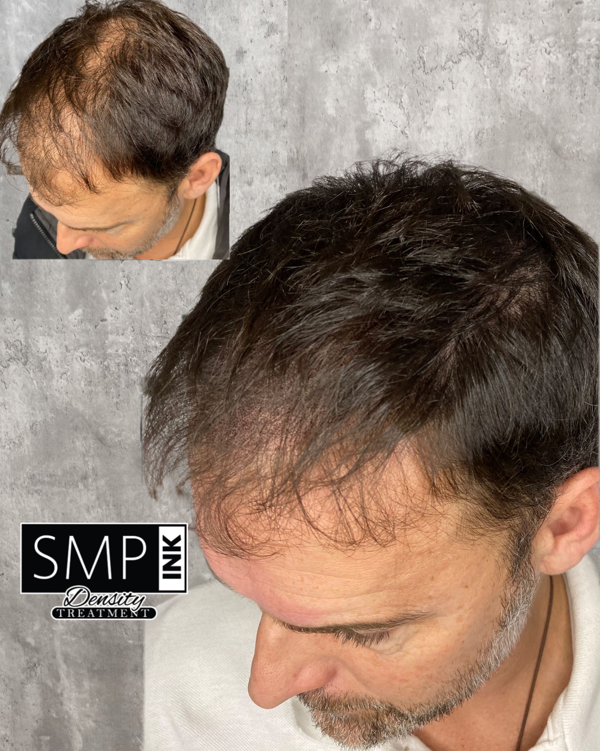 Top-down view of a man with thinning hair, showing dark hair and a receding hairline.