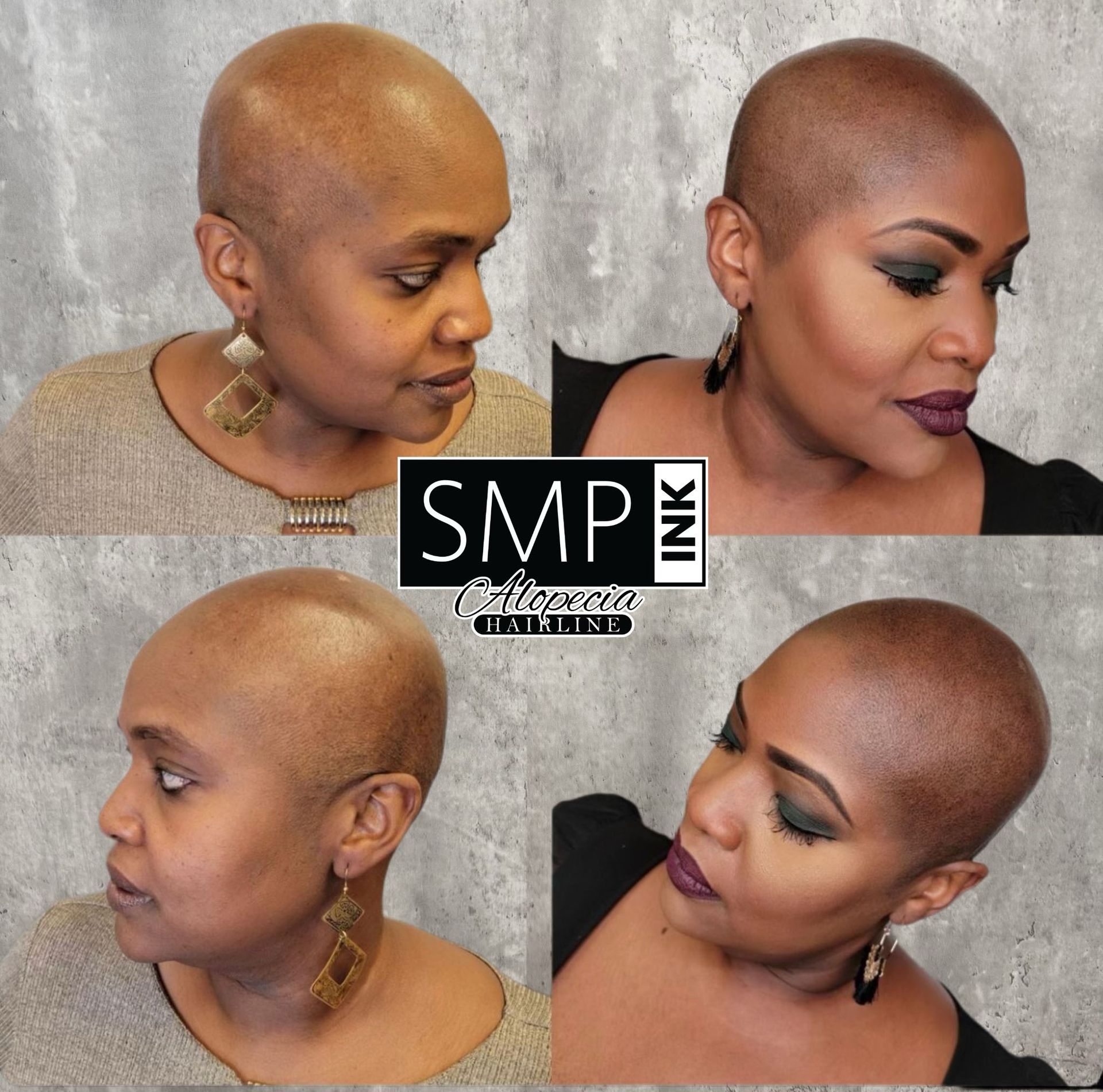 Four-panel collage showing scalp micropigmentation on a bald head from multiple angles.