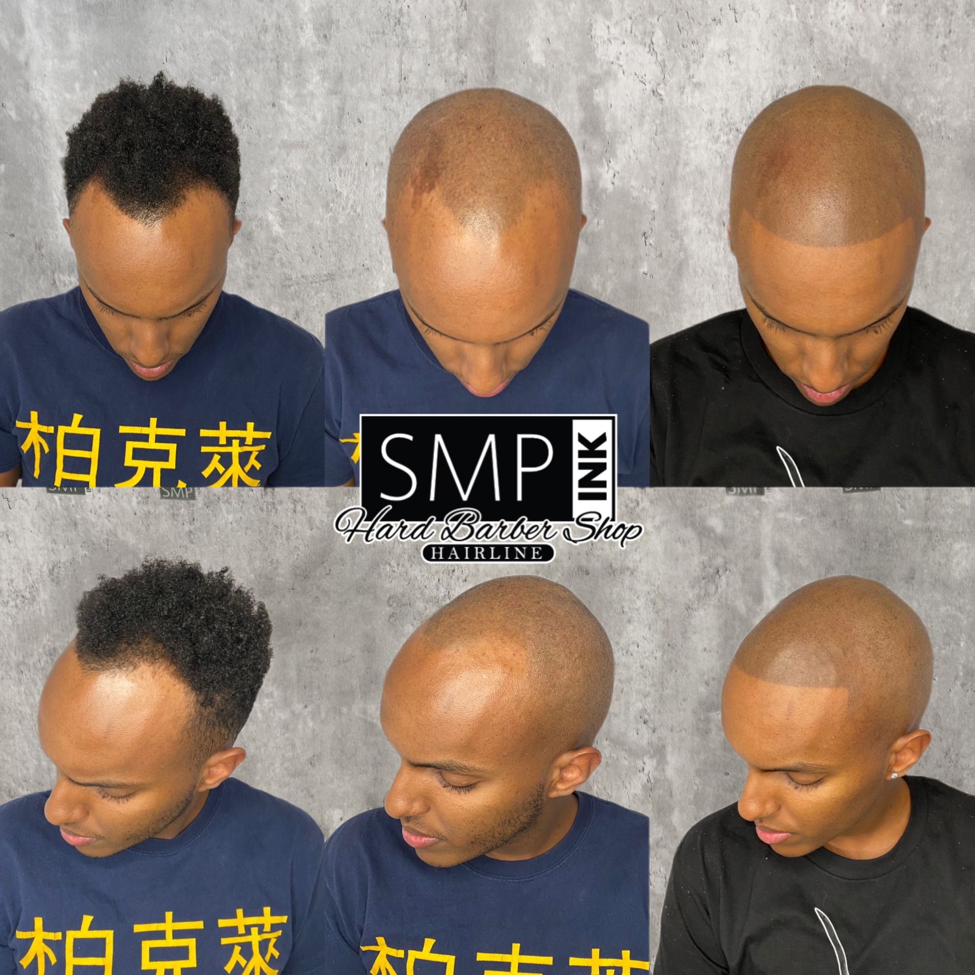 Before-and-after collage of a shaved head scalp micropigmentation treatment, with side and top views.