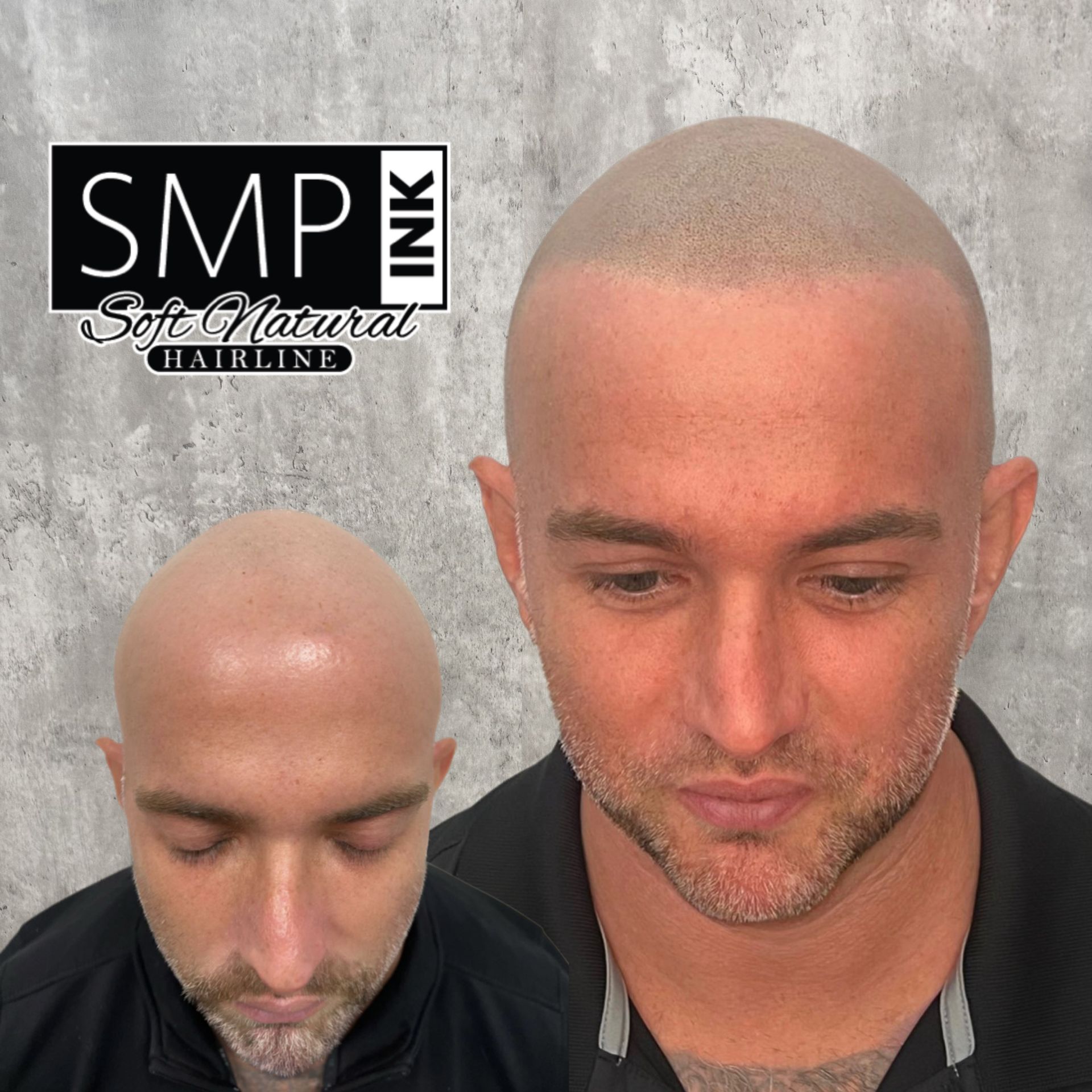Before-and-after scalp micropigmentation close-up, showing a bald head transformation with a natural hairline.