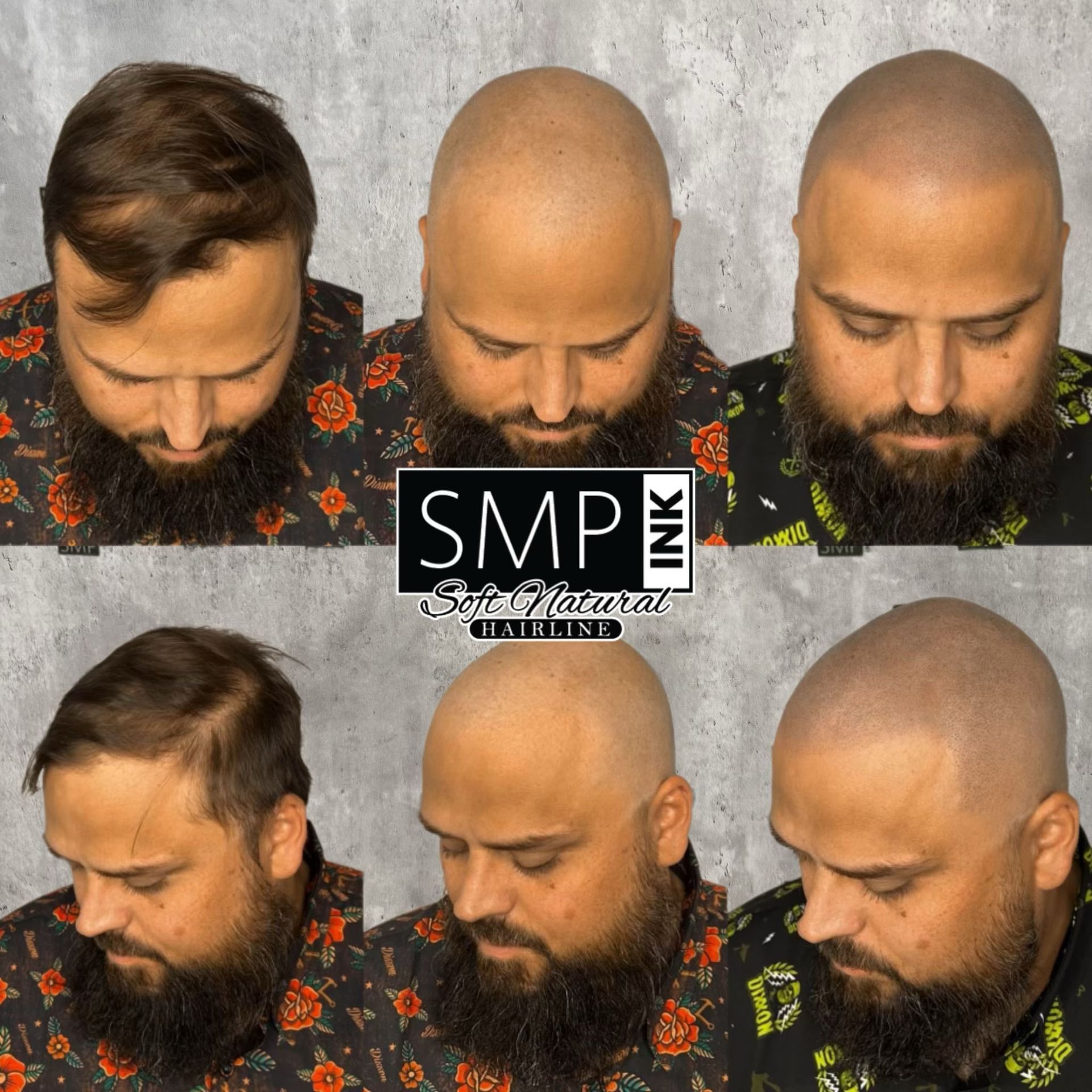 Collage of a bearded man before and after a scalp treatment, showing a shaved head and fuller hairline.
