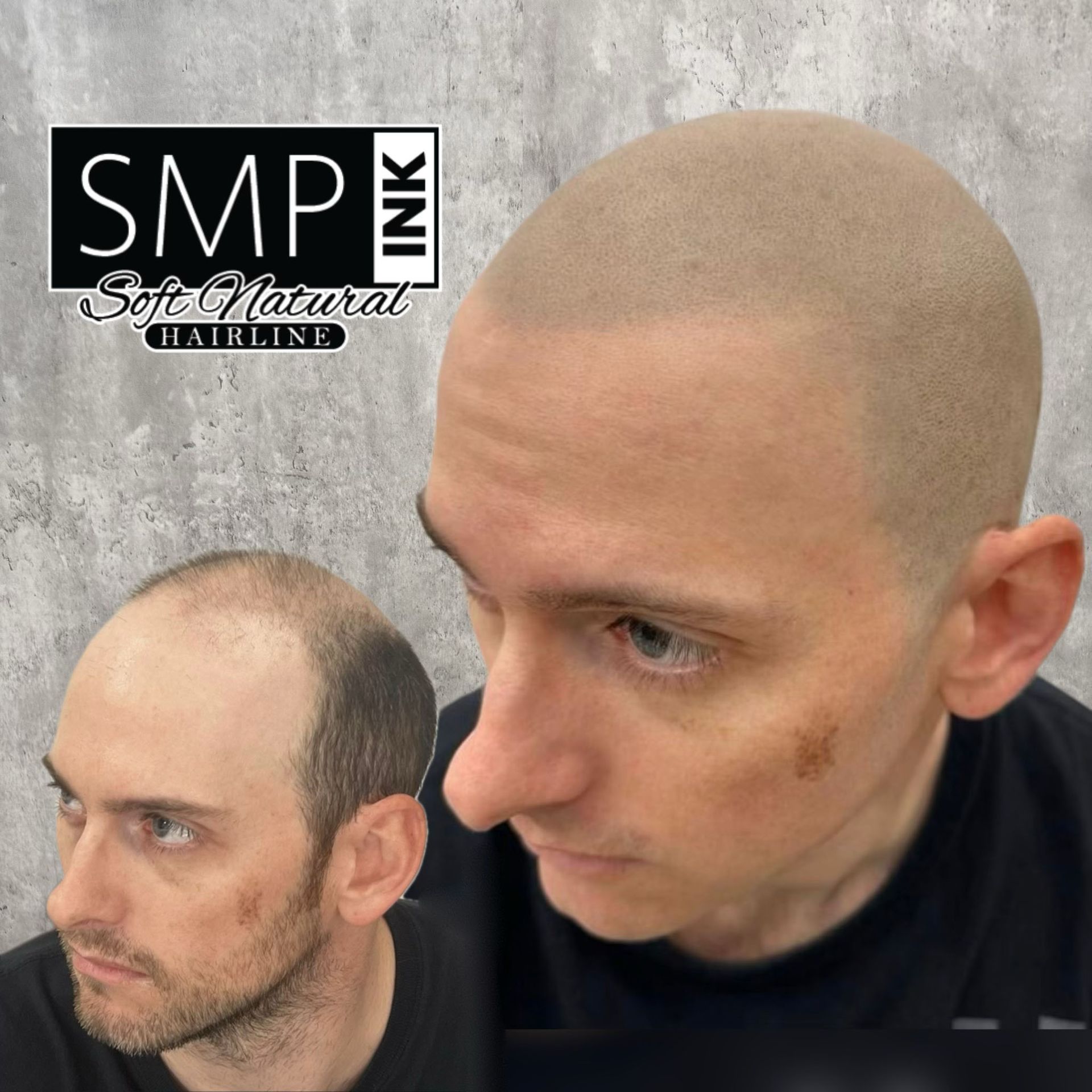 Before-and-after scalp micropigmentation results on a bald head, with logo in the top left.