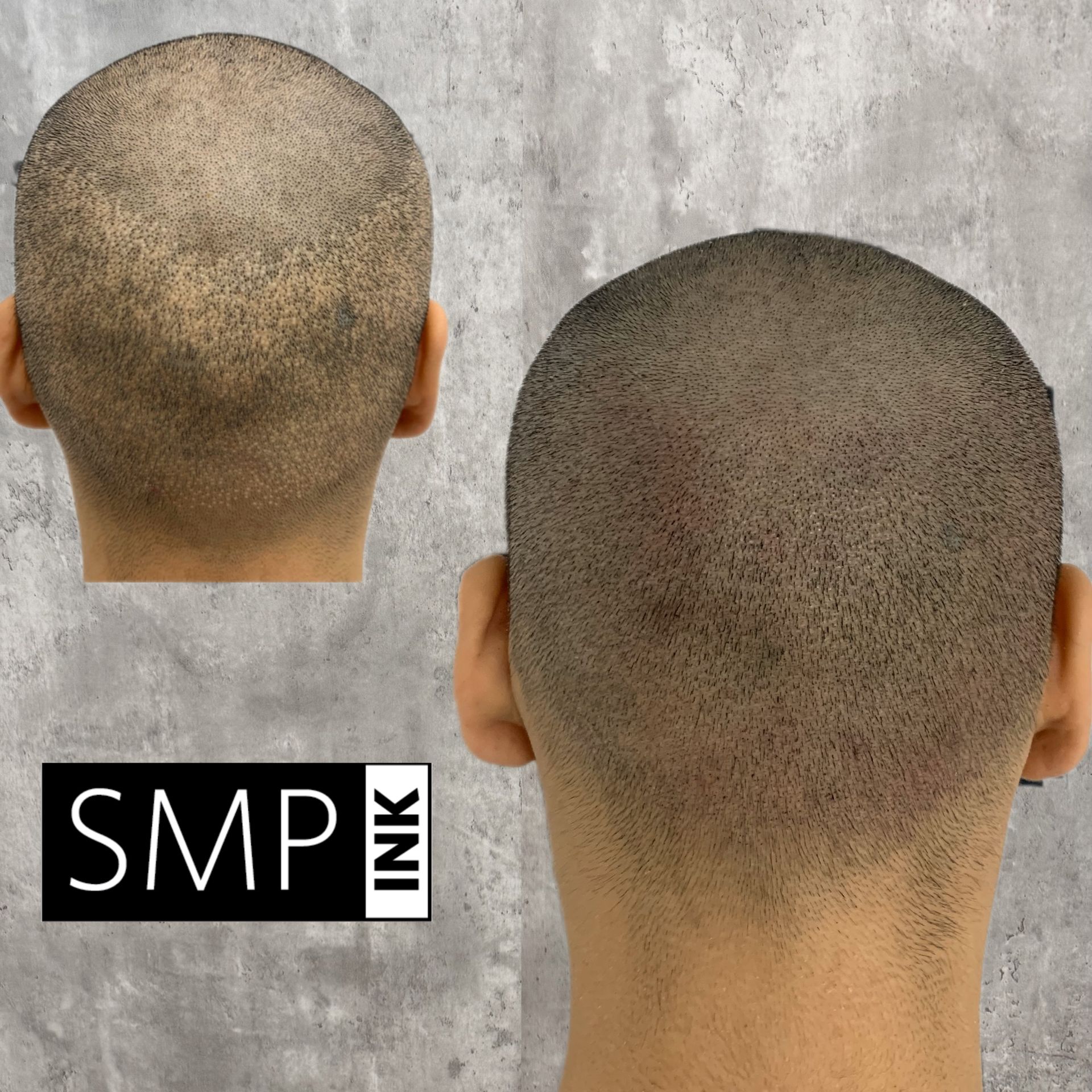 Two views of a shaved scalp with SMP hairline effect on a gray background