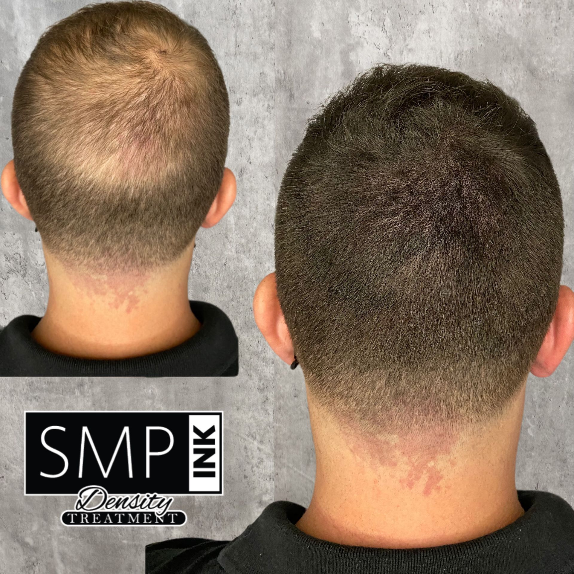Before and after scalp microblading close-up, showing thinning hair on the left and fuller coverage on the right