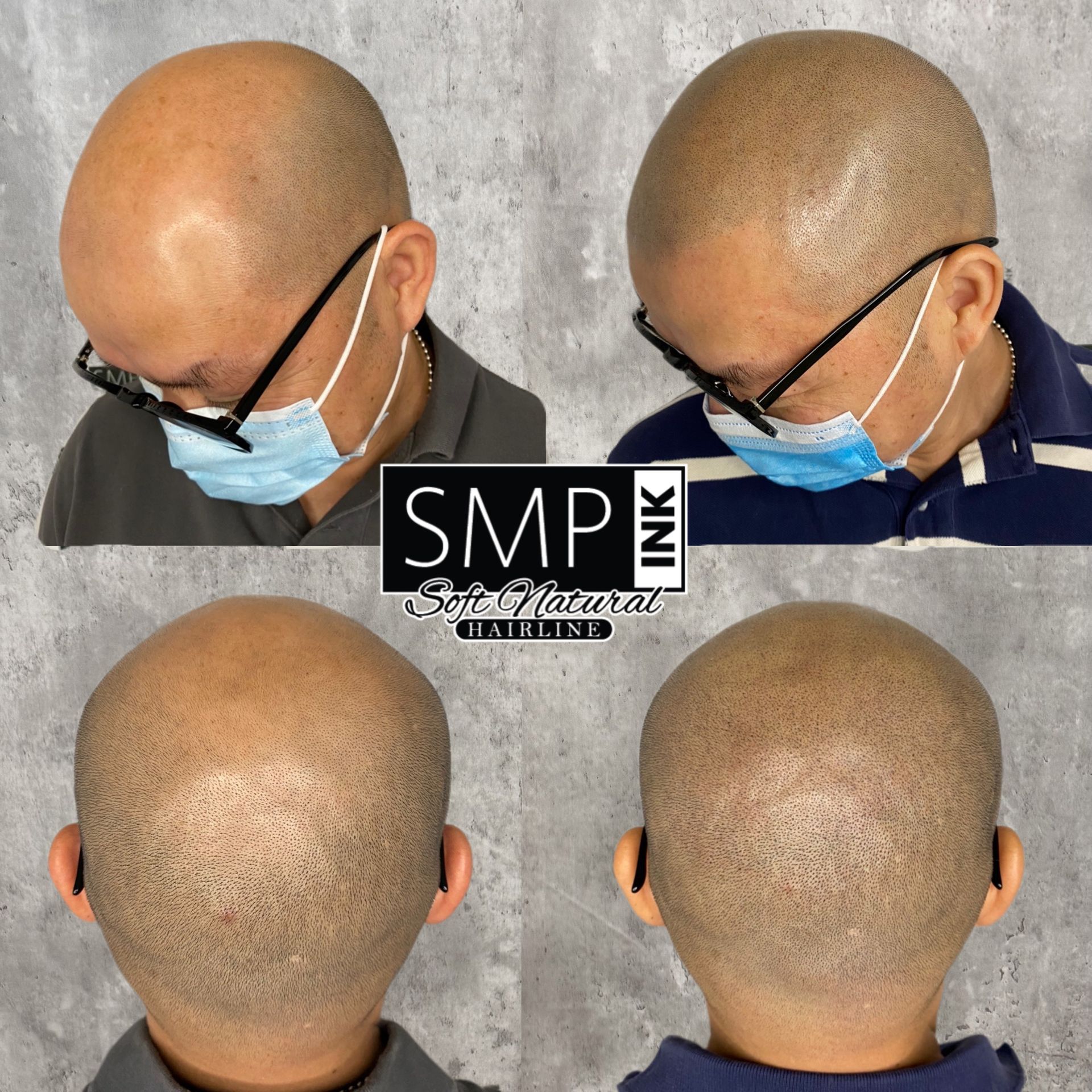 Before-and-after scalp micropigmentation on a bald head, showing close-up views from multiple angles.