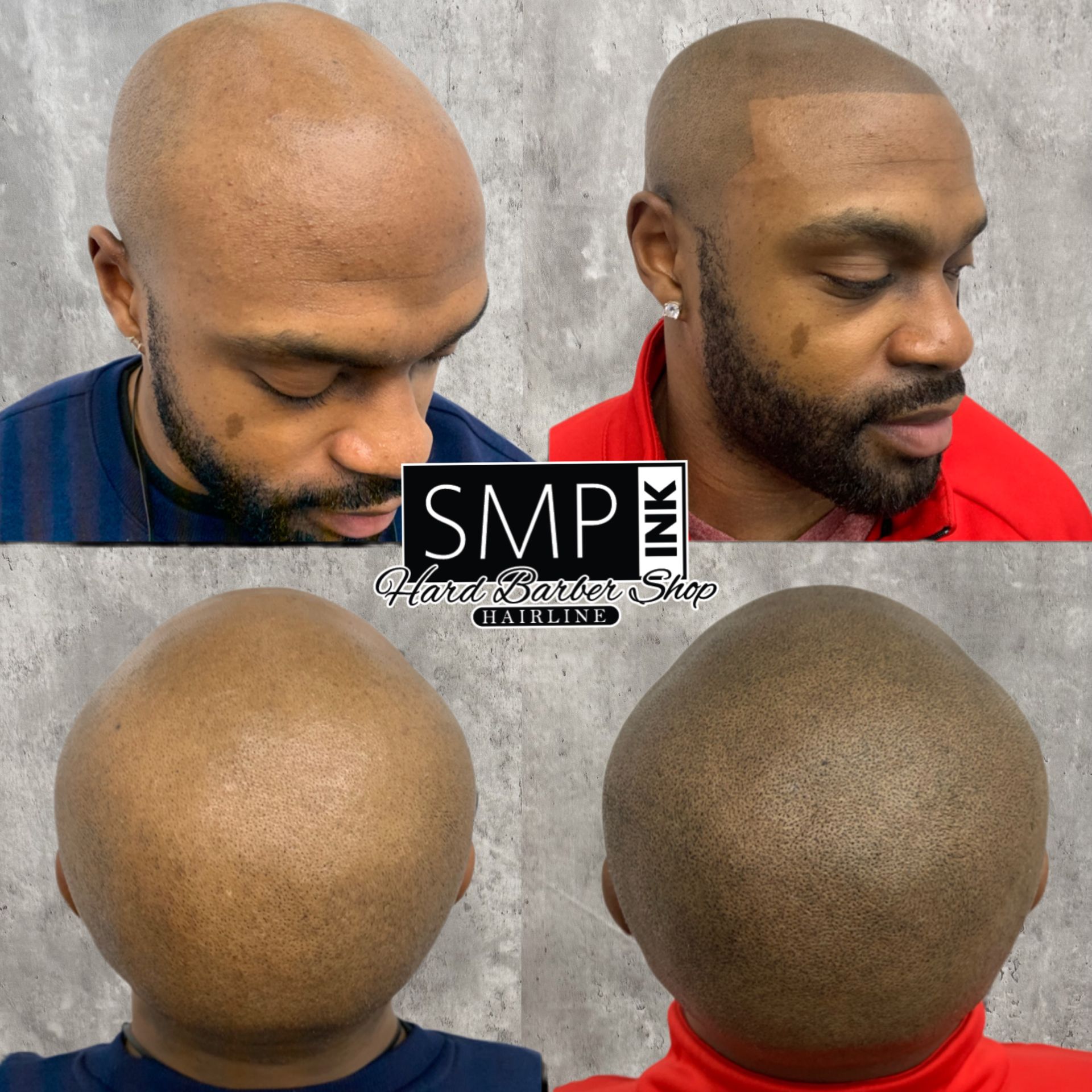 Before-and-after scalp micropigmentation photos showing a shaved head with fuller hairline effect.