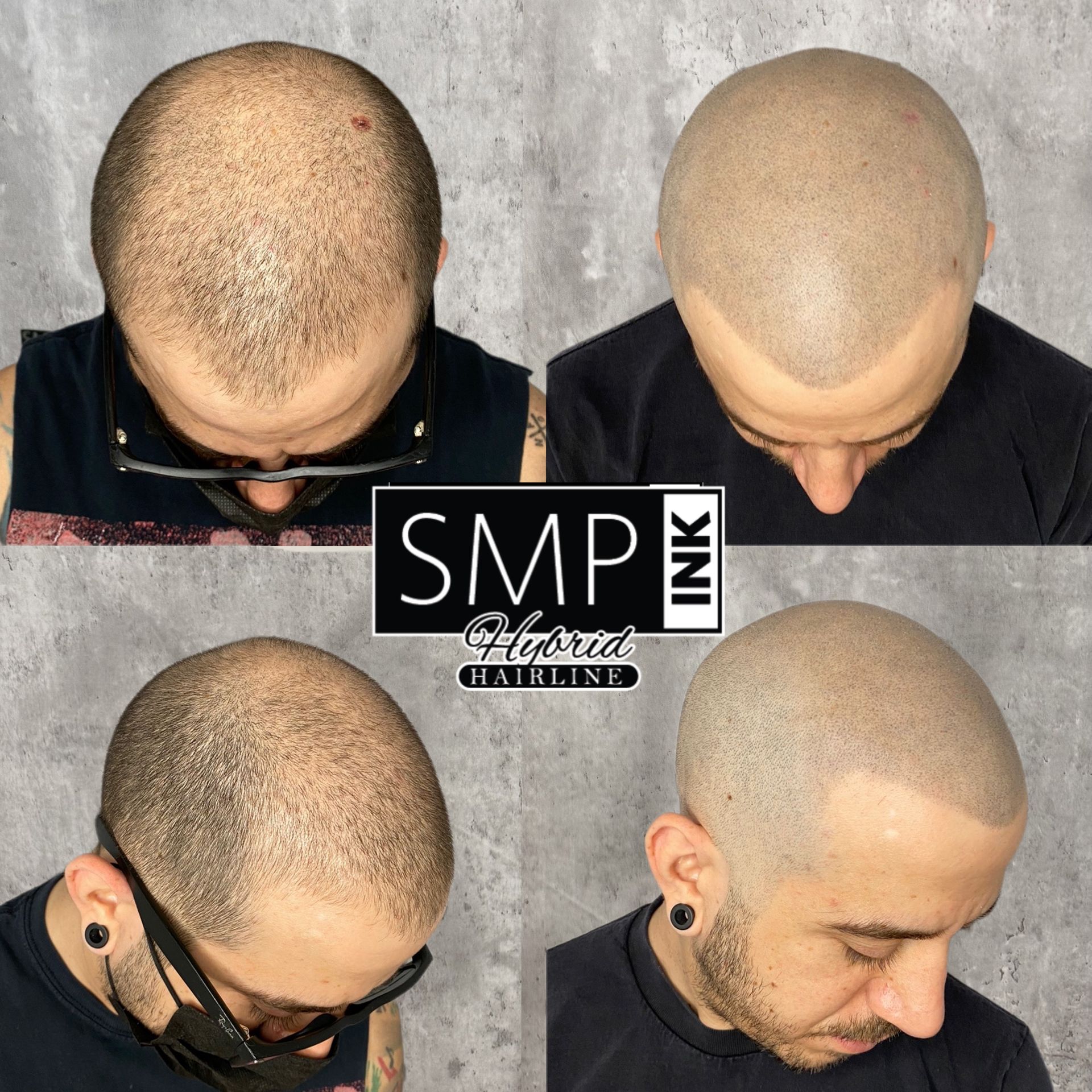 Before-and-after scalp micropigmentation results on a shaved head, shown from top and side views.