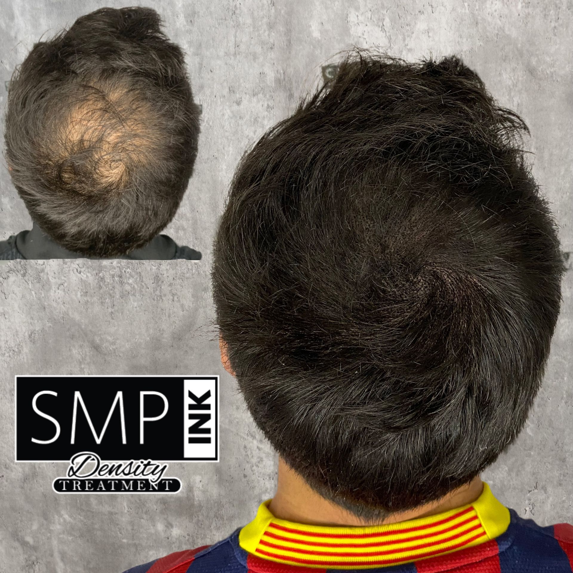 Scalp micropigmentation before-and-after view showing thinning crown transformed to fuller hair appearance
