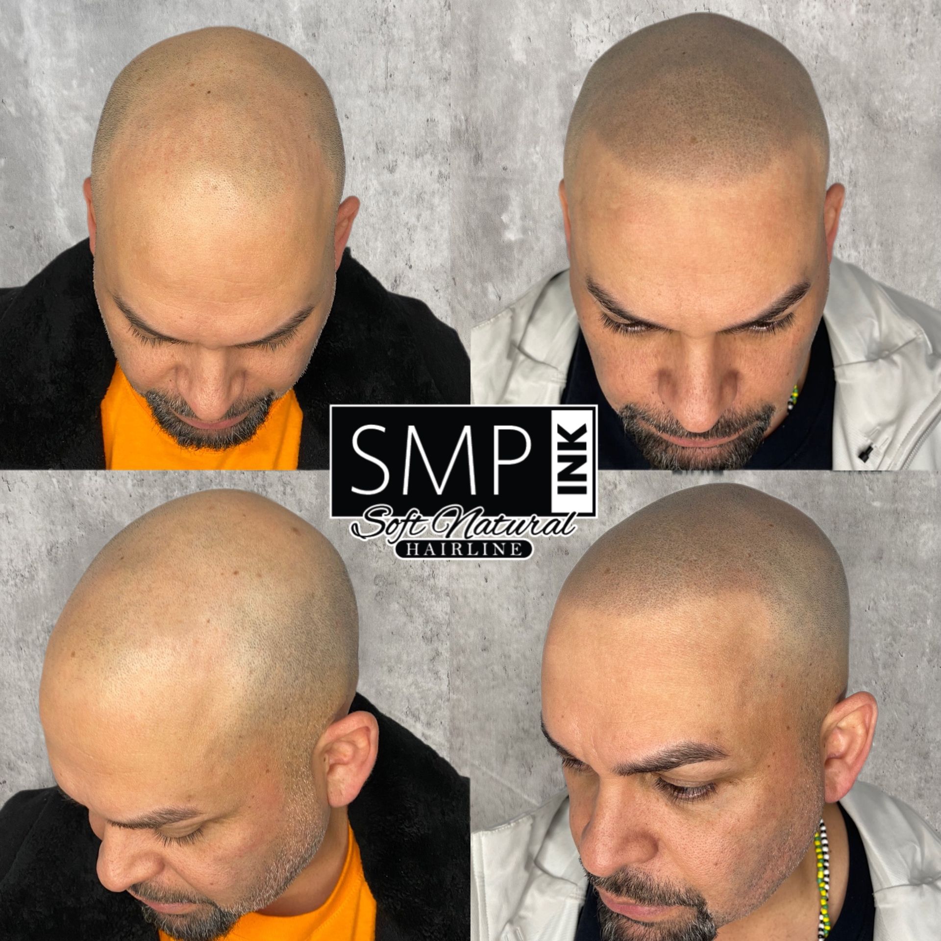 Before-and-after scalp micropigmentation results on a shaved head, shown in four close-up views.