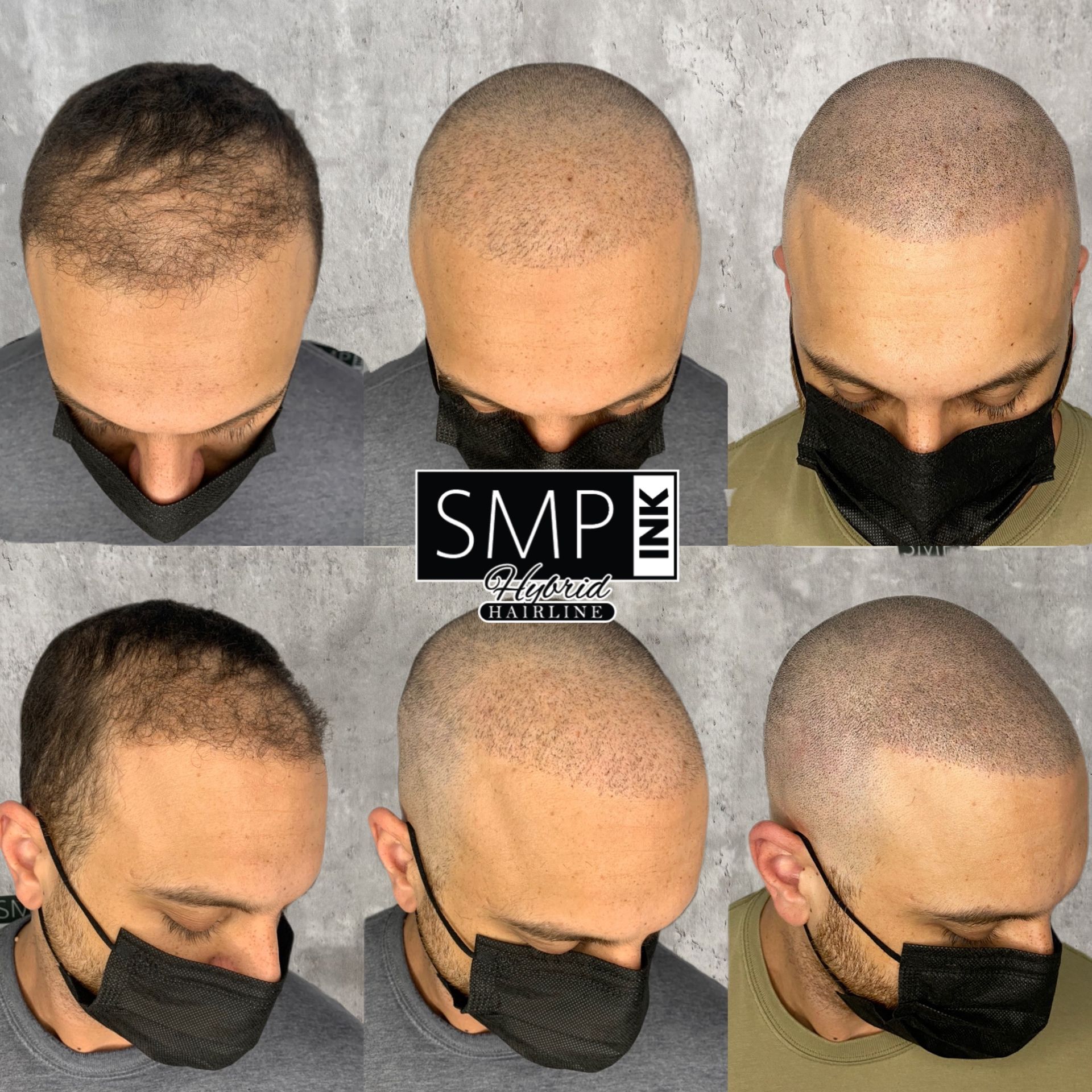 Six views of a man's shaved scalp showing SMP hairline tattoo results, with black mask and SMP ink logo.