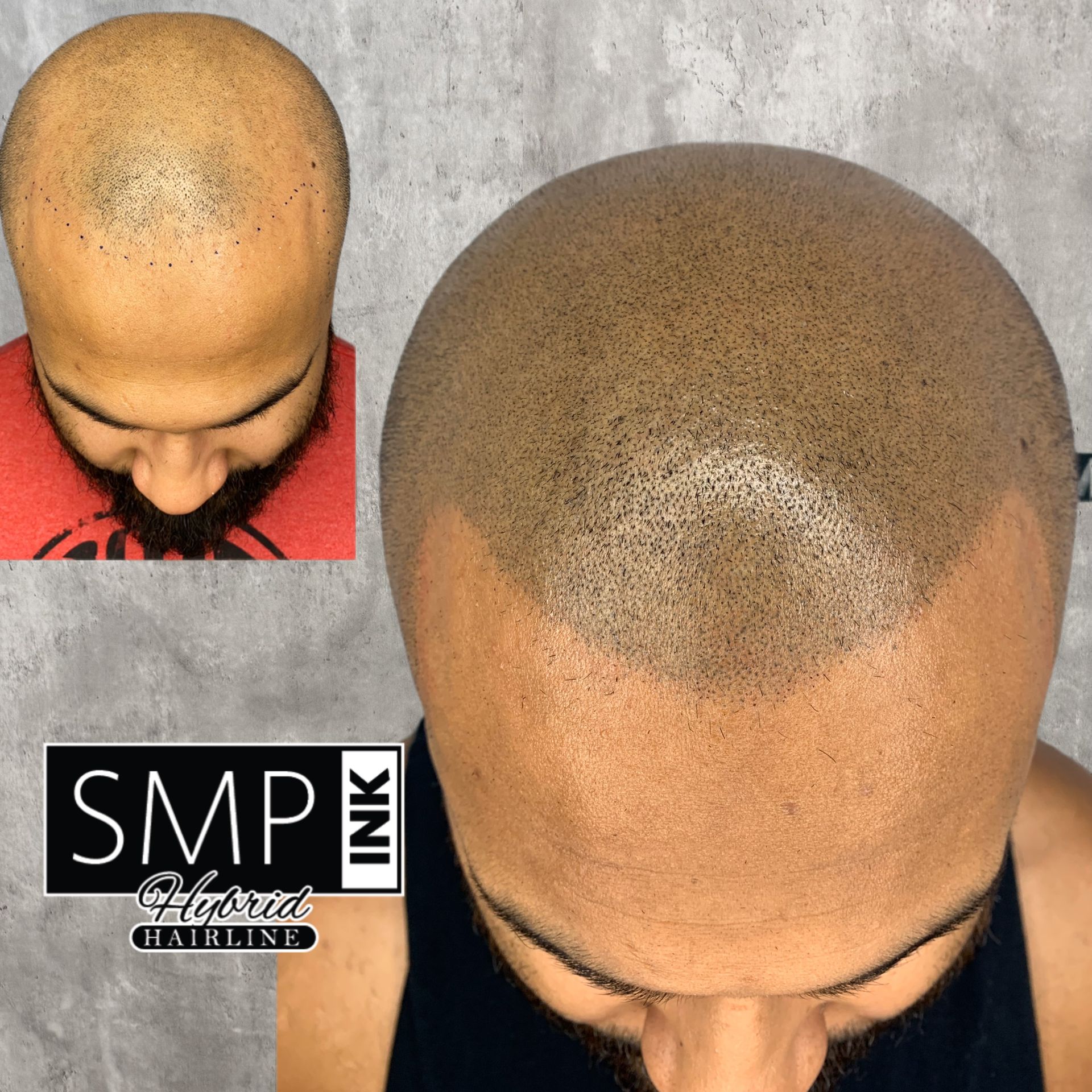 Top-down before-and-after scalp photos showing close-cropped hair thinning and scalp coverage.