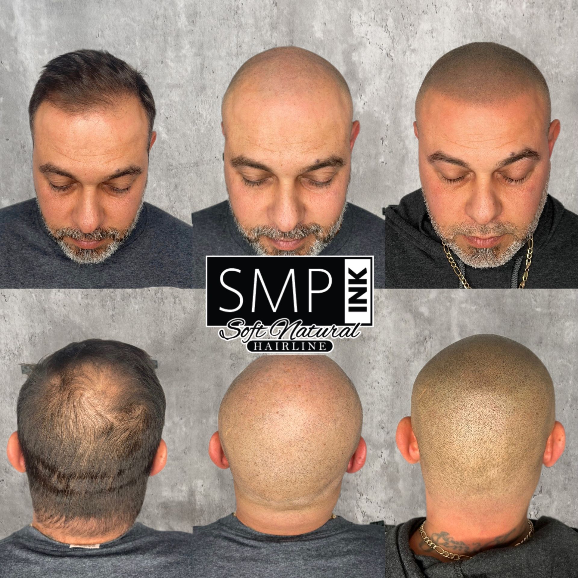 Before-and-after scalp micro pigmentation results showing top, front, and back views of a shaved head.