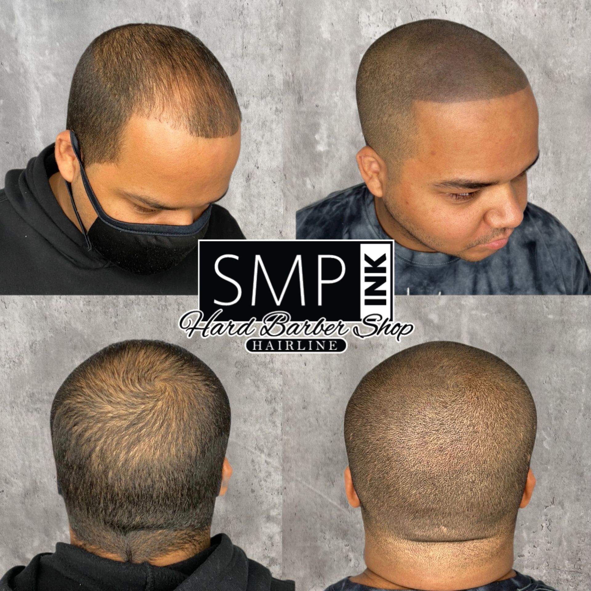 Before-and-after scalp micropigmentation: close-up head views with fuller-looking shaved hairline and crown.