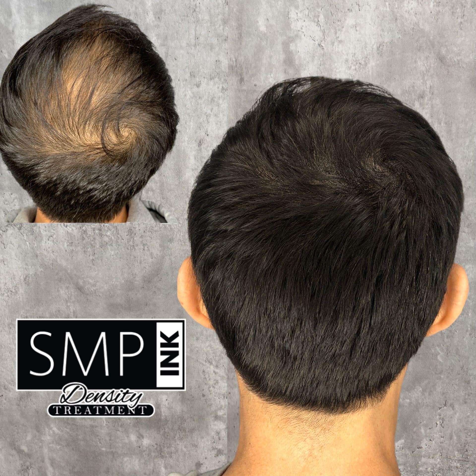 Before and after back view of short dark hair with a shaved neckline, showing scalp micropigmentation results.