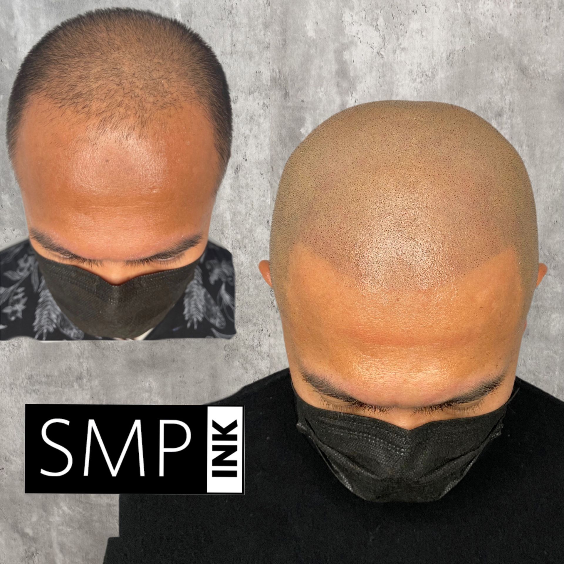 Two top-view scalp photos showing SMP results, with a black face mask and SMP INK logo.