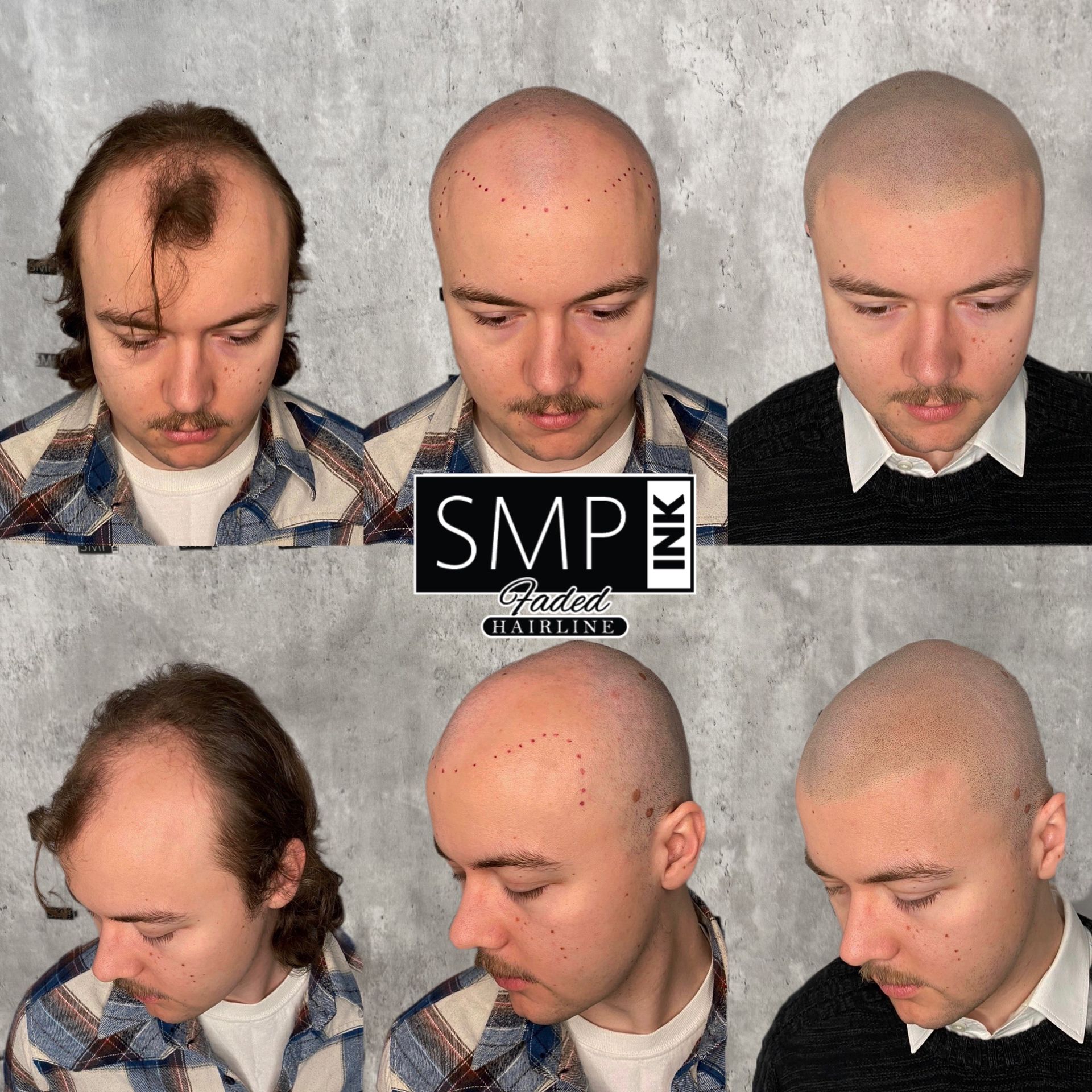 Hairline transformation collage showing thinning hair and a shaved head, with SMP logo in the center.