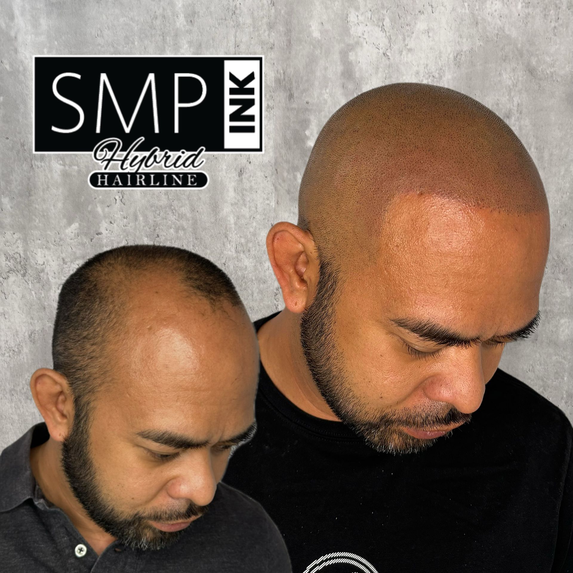 Before-and-after scalp restoration promo showing a bald scalp becoming fuller hair, with SMP Ink logo.