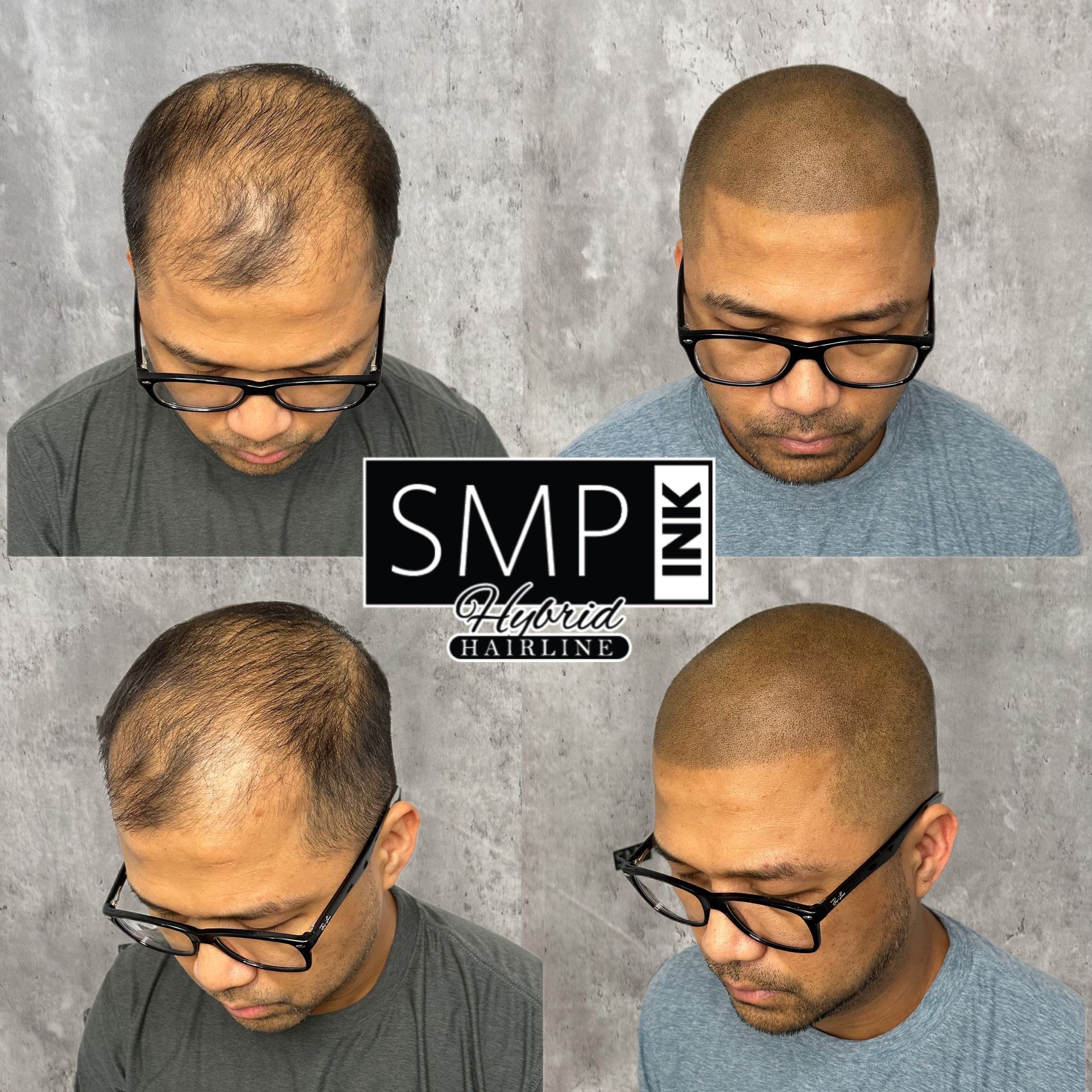Before-and-after scalp micropigmentation results shown in four views, with a fuller-looking hairline.