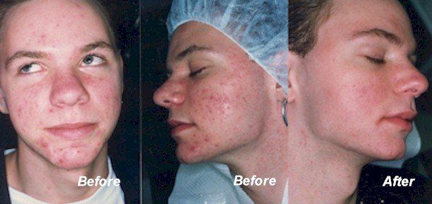 Before And After Face Acne Treatment