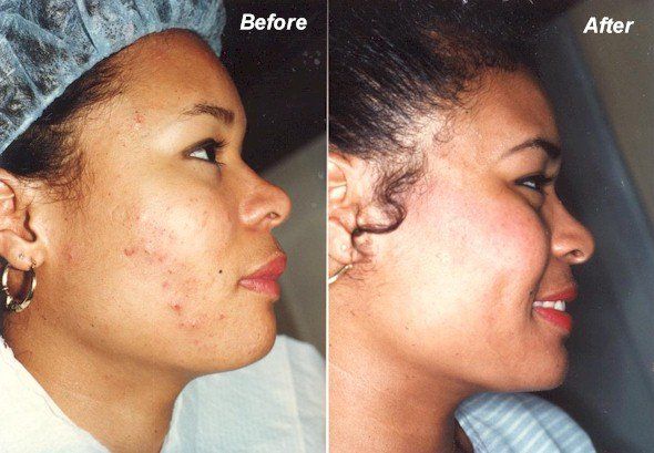 Before And After Face Of A Woman