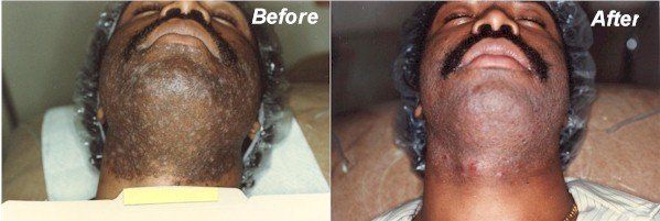 Before And After Face Face Treatment