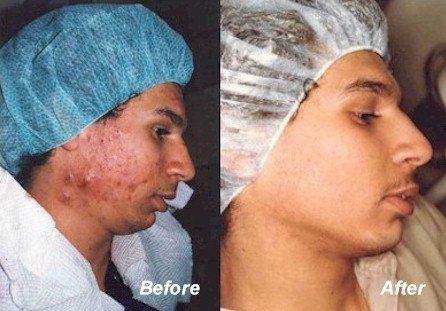 Before And After Acne Treatment
