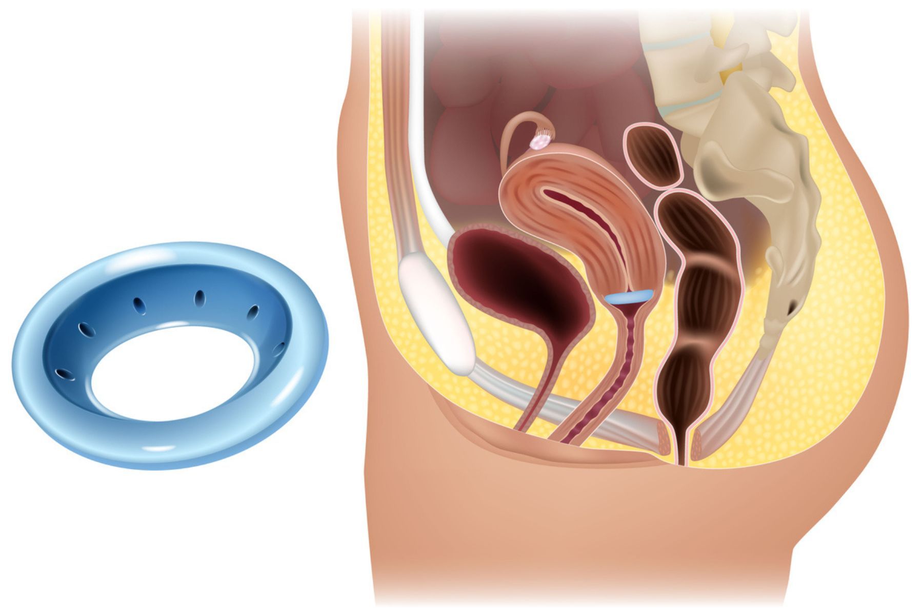 Vaginal Pessary