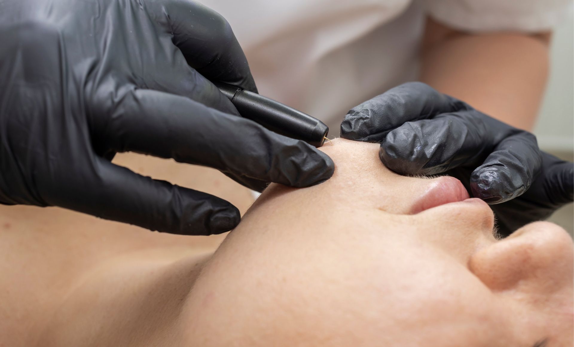 Person receiving a facial procedure, with gloved hands using a tool near their nose.