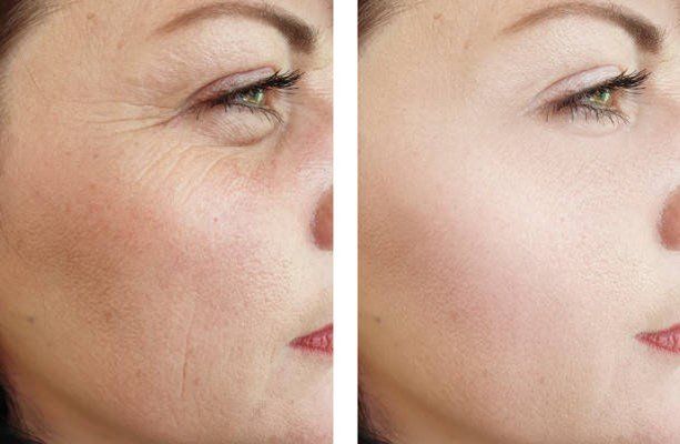 Crow's Feet (wrinkles around eyes)