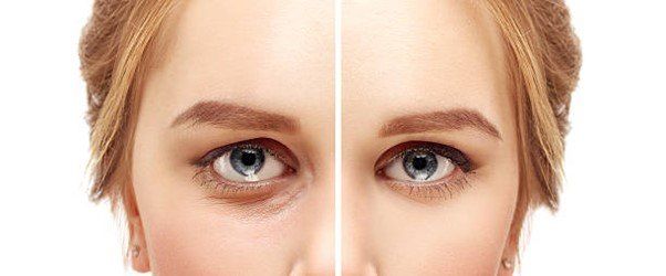 What Are The Benefits Of Dermal Filler?